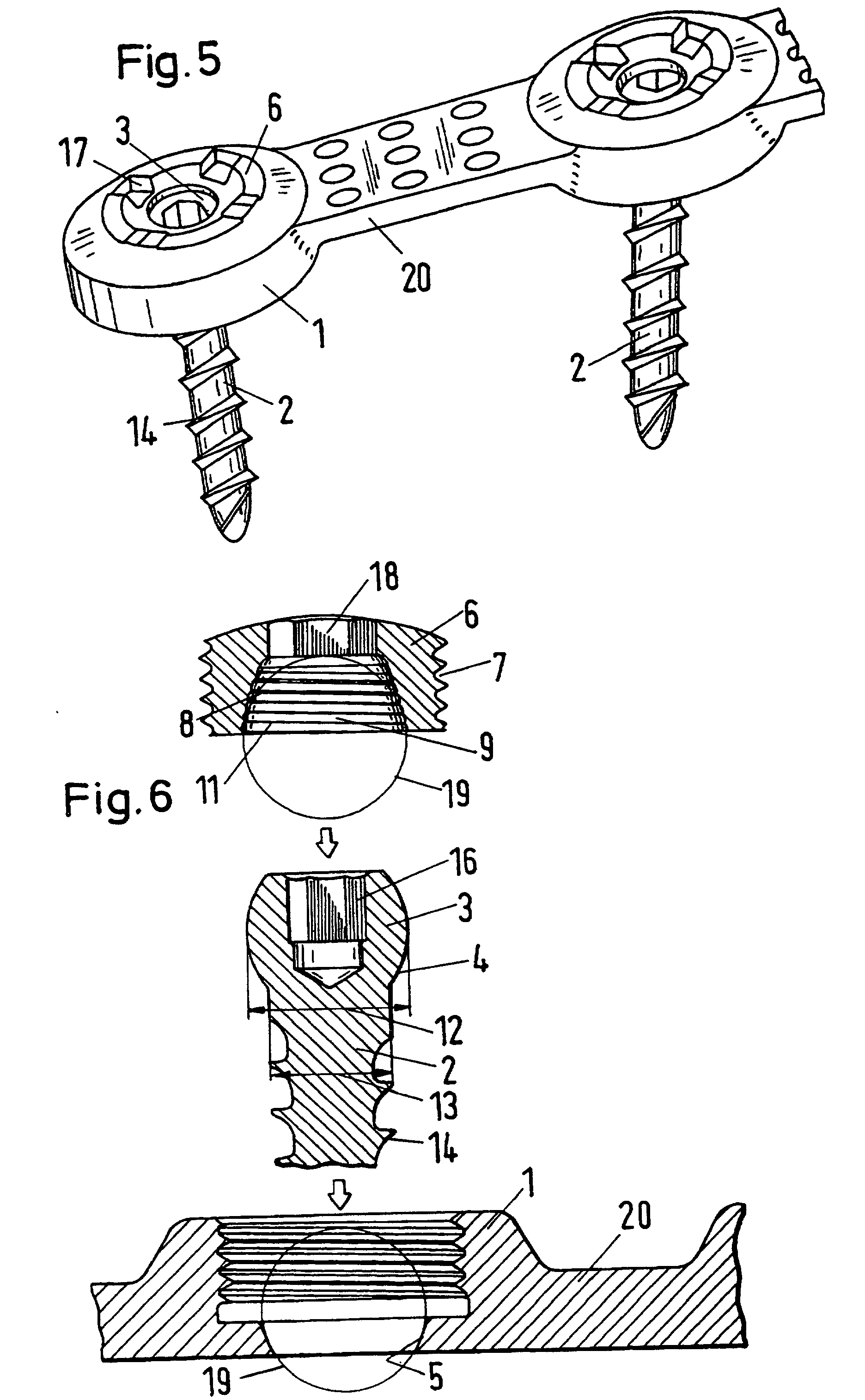 Osteosynthesis plates screws