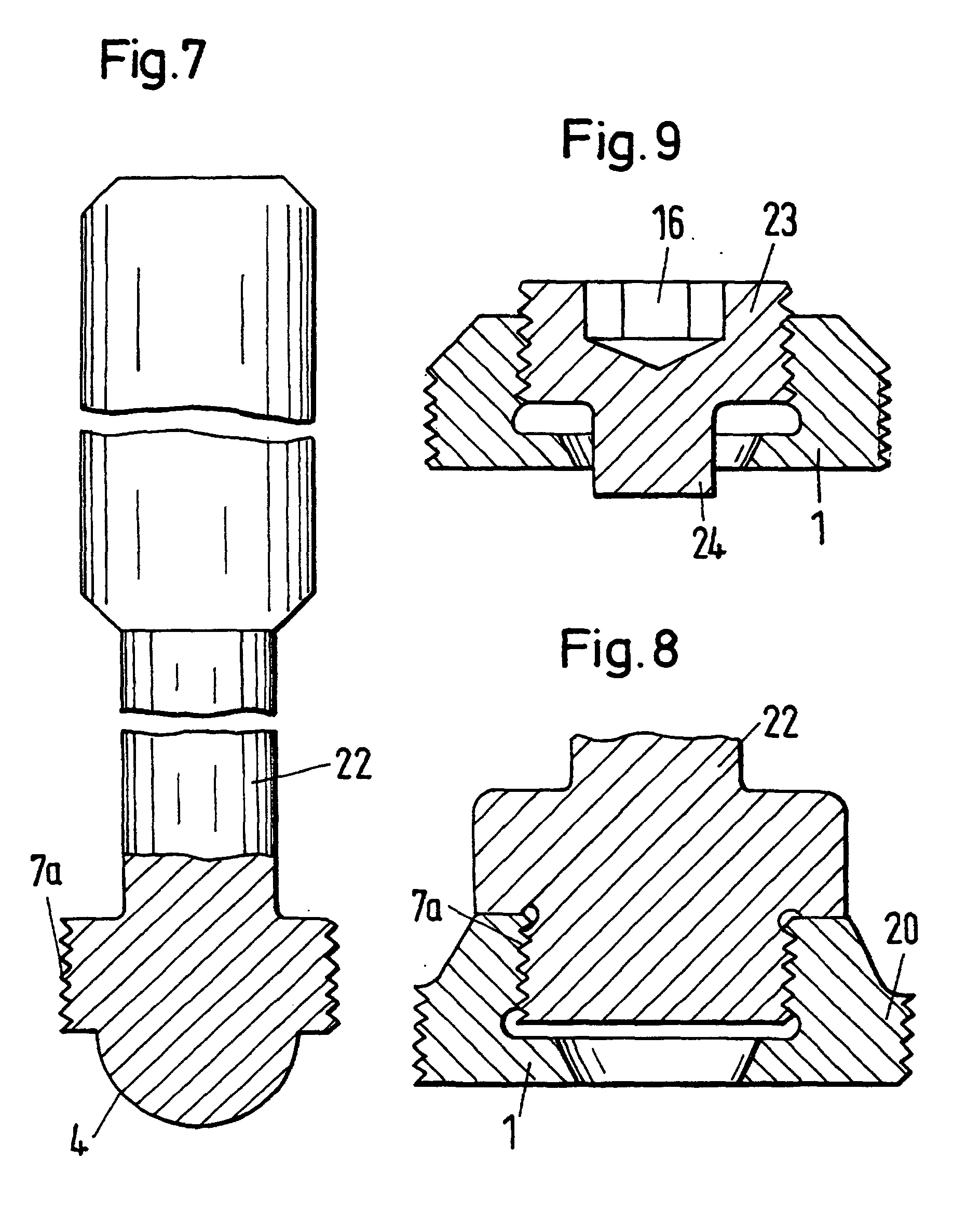 osteosynthesis screws Looking for online definition of osteosynthesis in the medical dictionary osteosynthesis explanation free what is osteosynthesis meaning of osteosynthesis. osteosynthesis screws Looking for online definition of osteosynthesis in the medical dictionary osteosynthesis explanation free what is osteosynthesis meaning of osteosynthesis.