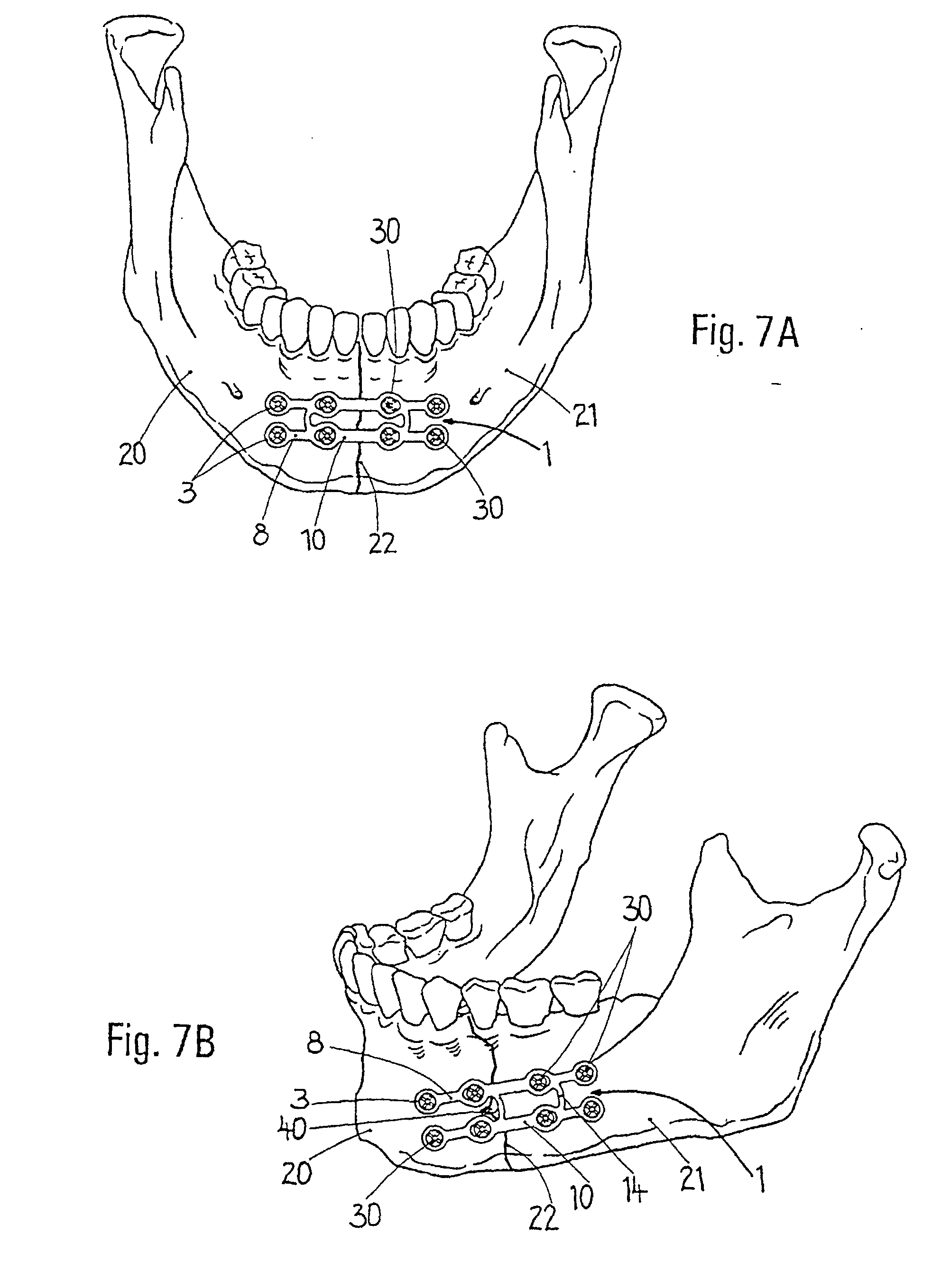 treatment of mandibular fractures by means of compression osteosynthesis Management of mandibular fractures with conventional miniplates - a mandibular fractures is with non-compression mini plates which relieves the champy's line of osteosynthesis miniplates gave maximum stability and osteosynthesis of the mandible are based on specific technical refinements in the methods of. treatment of mandibular fractures by means of compression osteosynthesis Management of mandibular fractures with conventional miniplates - a mandibular fractures is with non-compression mini plates which relieves the champy's line of osteosynthesis miniplates gave maximum stability and osteosynthesis of the mandible are based on specific technical refinements in the methods of.