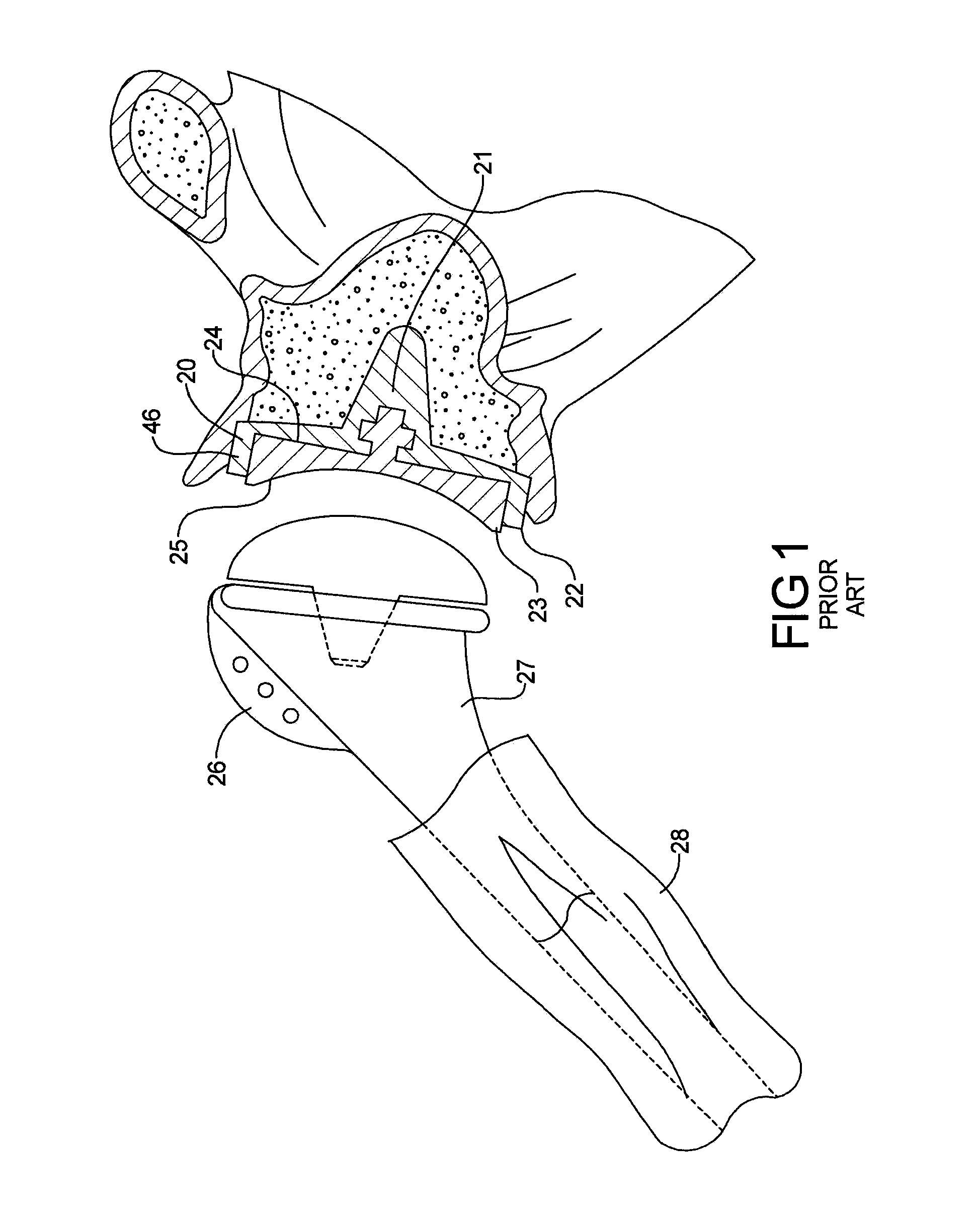 reverse shoulder prothesis International journal of the principle of the reverse shoulder prosthesis is that the head which forms a part of a sphere is xed to the glenoid and the cup in which it articulates is on the humeral side from a historical perspective. reverse shoulder prothesis International journal of the principle of the reverse shoulder prosthesis is that the head which forms a part of a sphere is xed to the glenoid and the cup in which it articulates is on the humeral side from a historical perspective.
