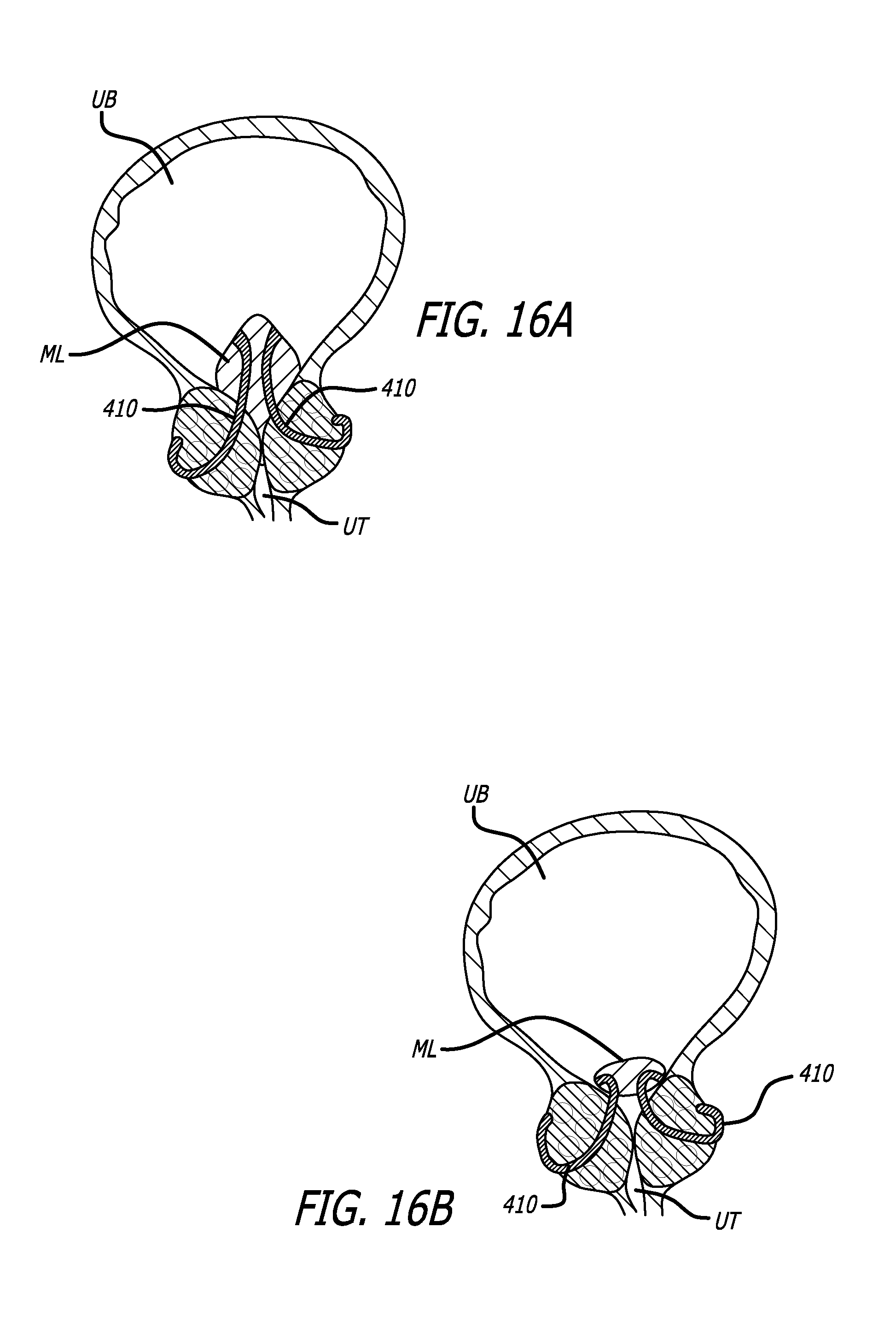 Middle+Lobe+Prostate Patent US20130267772 - Median lobe band implant apparatus and method ...