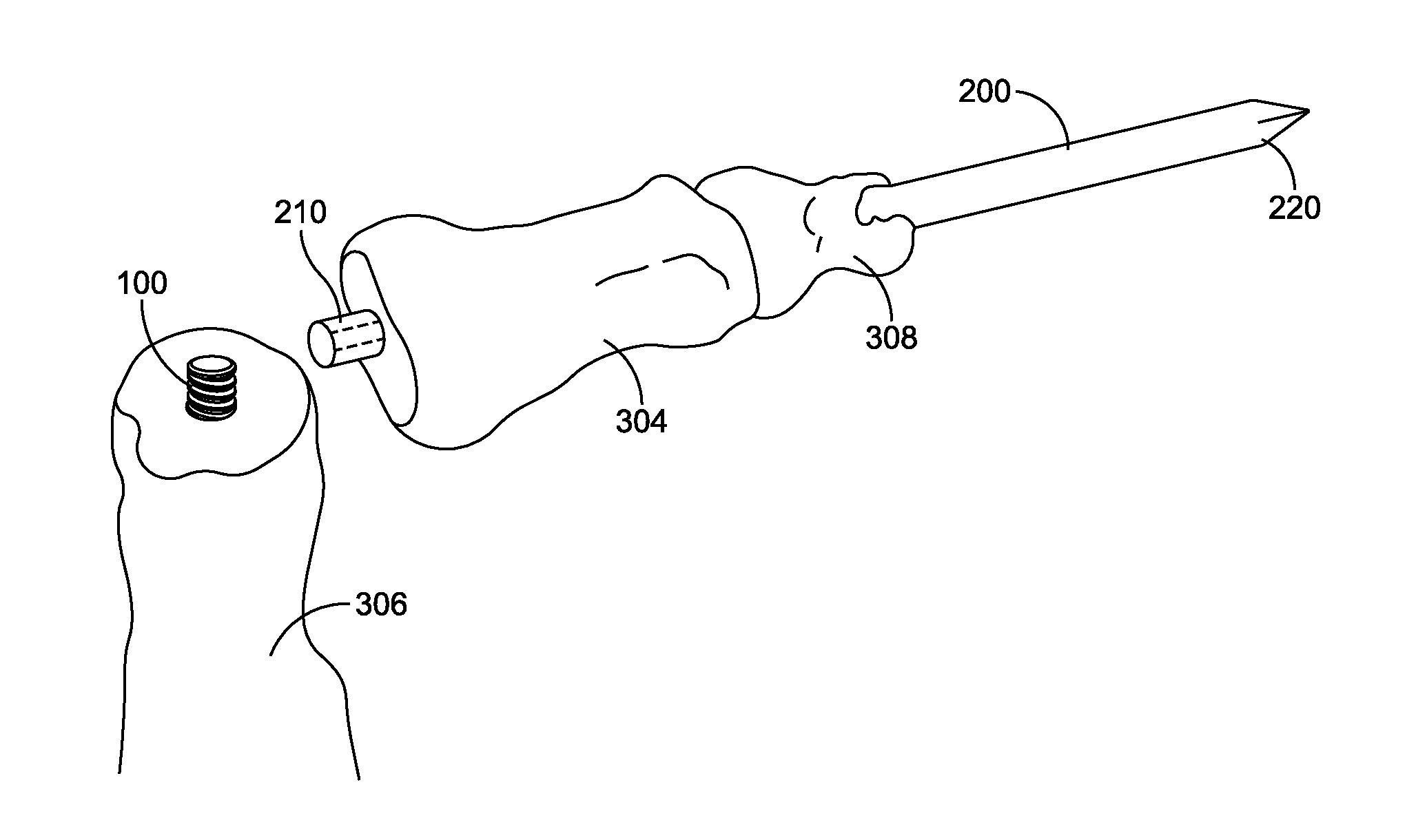 Hammertoe