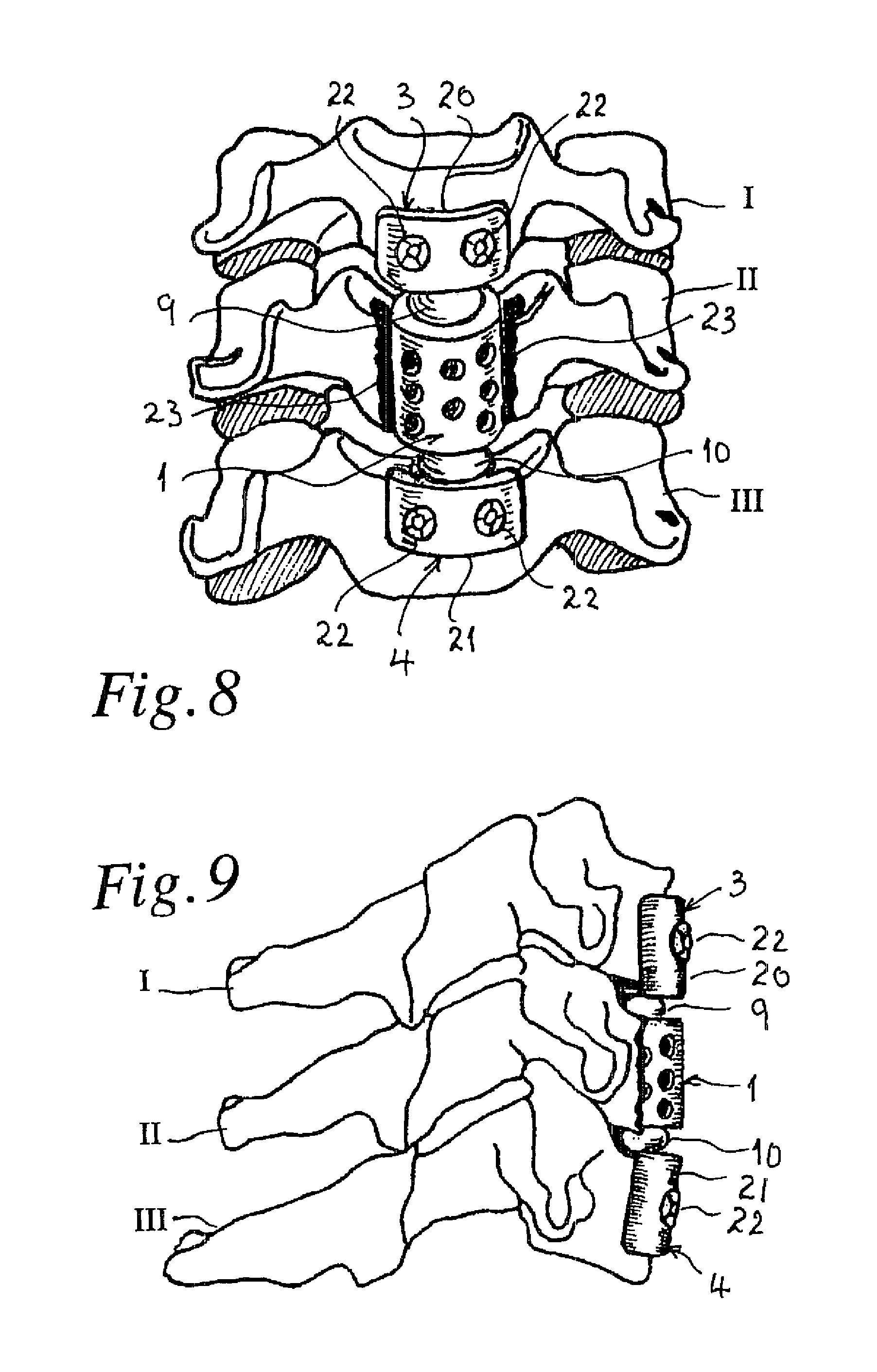spinous prothesis spinous prothesis