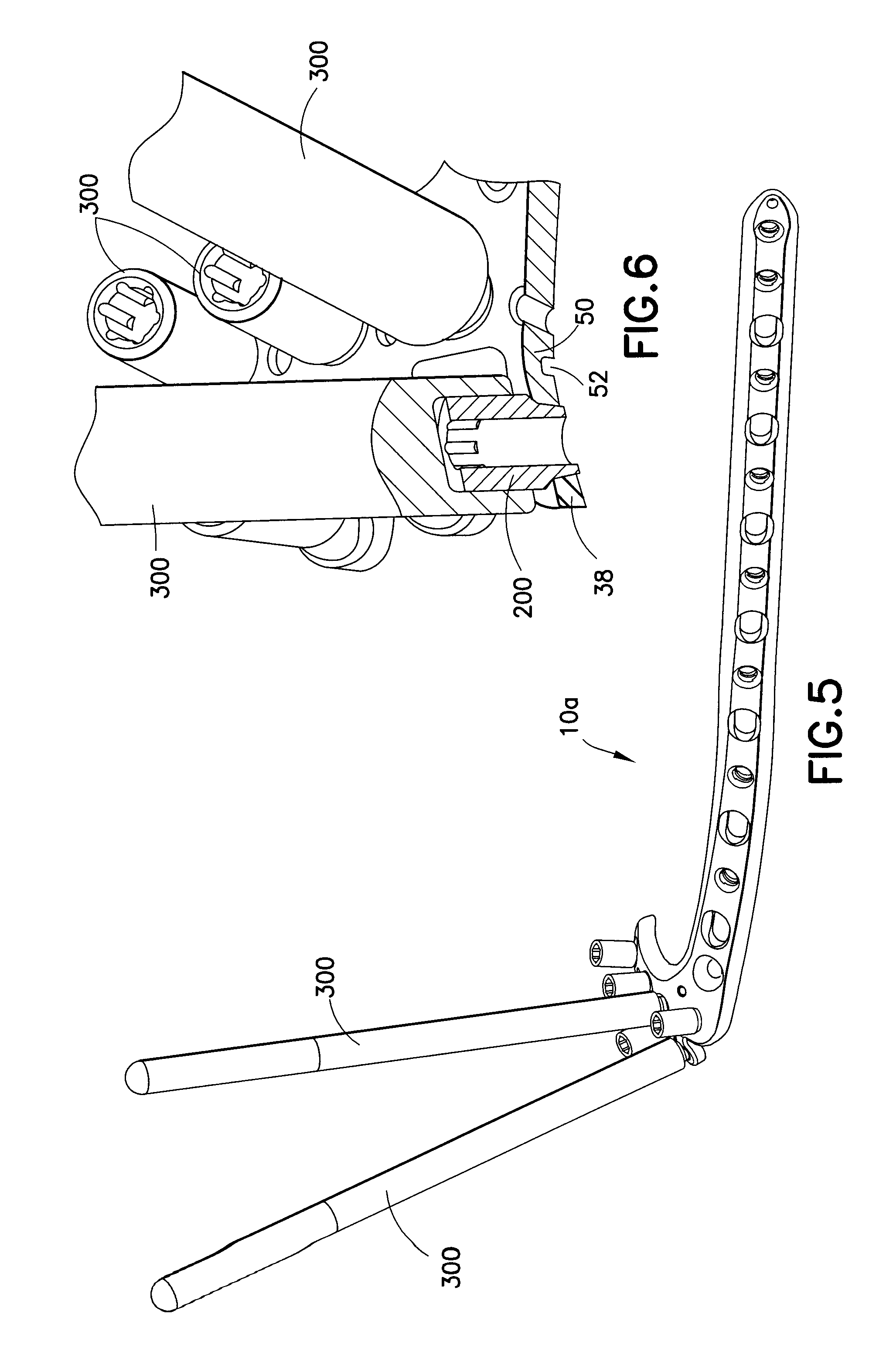 Ring slot tibia