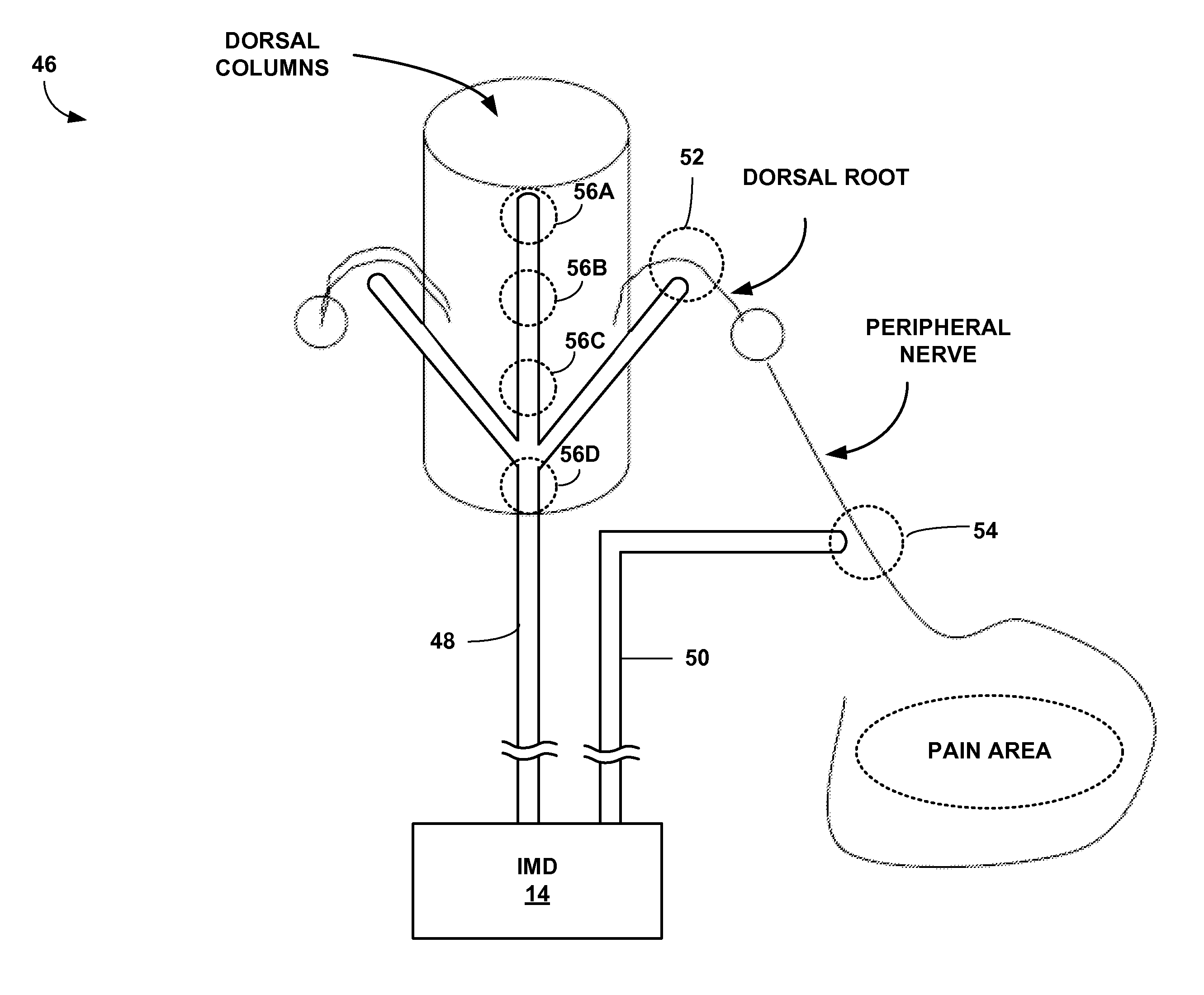 dorsal column stimulator dorsal column stimulator