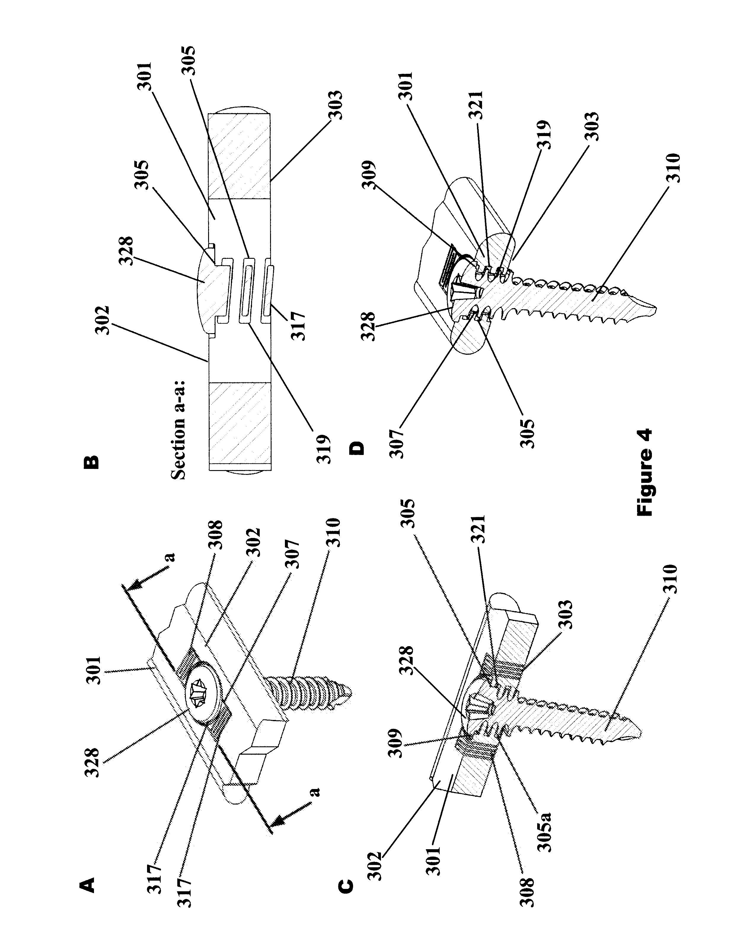 elastic plate osteosynthesis Without direct visualization, minimally invasive osteosynthesis (mio) known as elastic plate osteosynthesis using this technique. elastic plate osteosynthesis Without direct visualization, minimally invasive osteosynthesis (mio) known as elastic plate osteosynthesis using this technique.