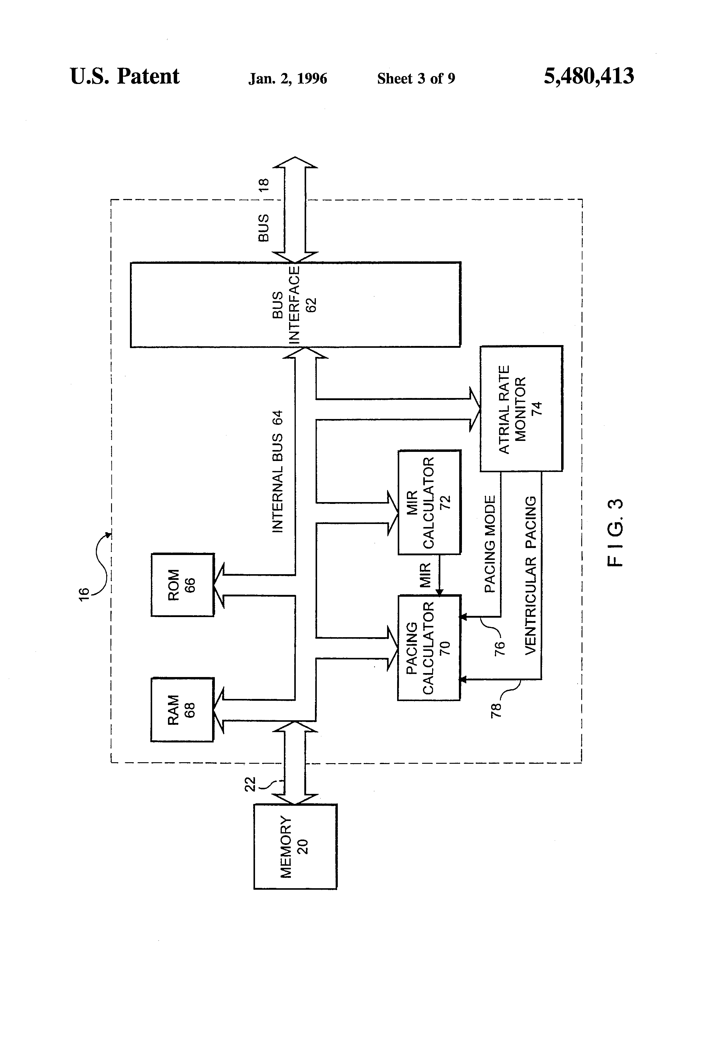 Single-Chamber SVT-VT discriminators