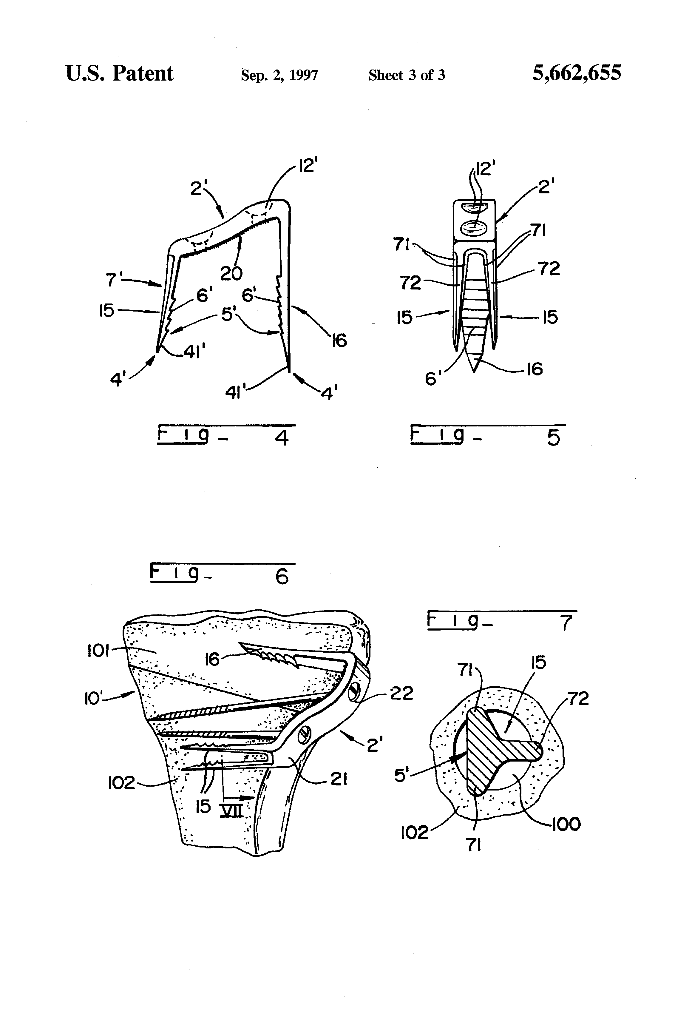 elastic plate osteosynthesis Without direct visualization, minimally invasive osteosynthesis (mio) known as elastic plate osteosynthesis using this technique. elastic plate osteosynthesis Without direct visualization, minimally invasive osteosynthesis (mio) known as elastic plate osteosynthesis using this technique.