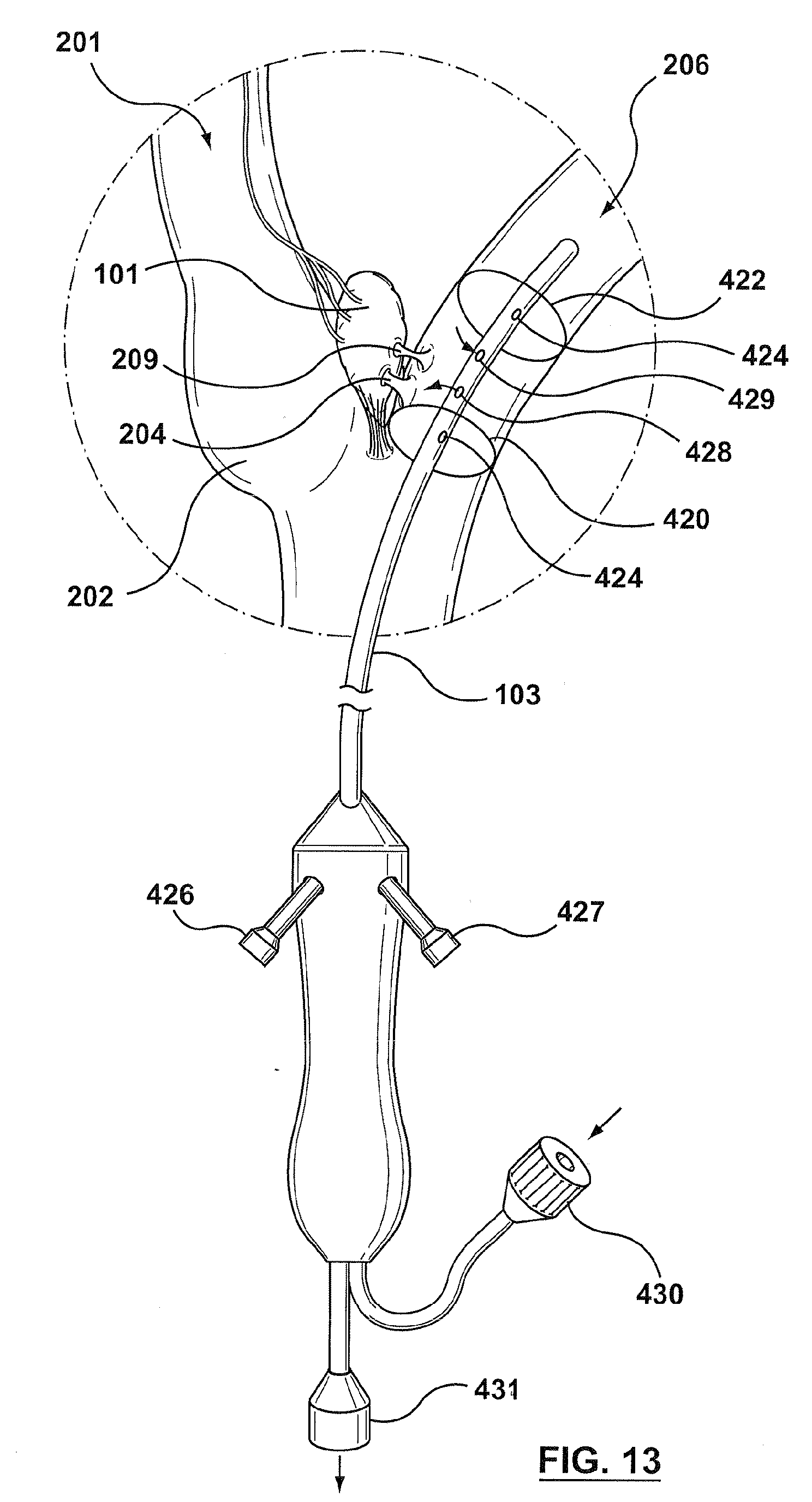 Epa1 Endovascular Carotid Body Ablation Catheter For Sympathetic Rebalancing Of Patient Google Patents