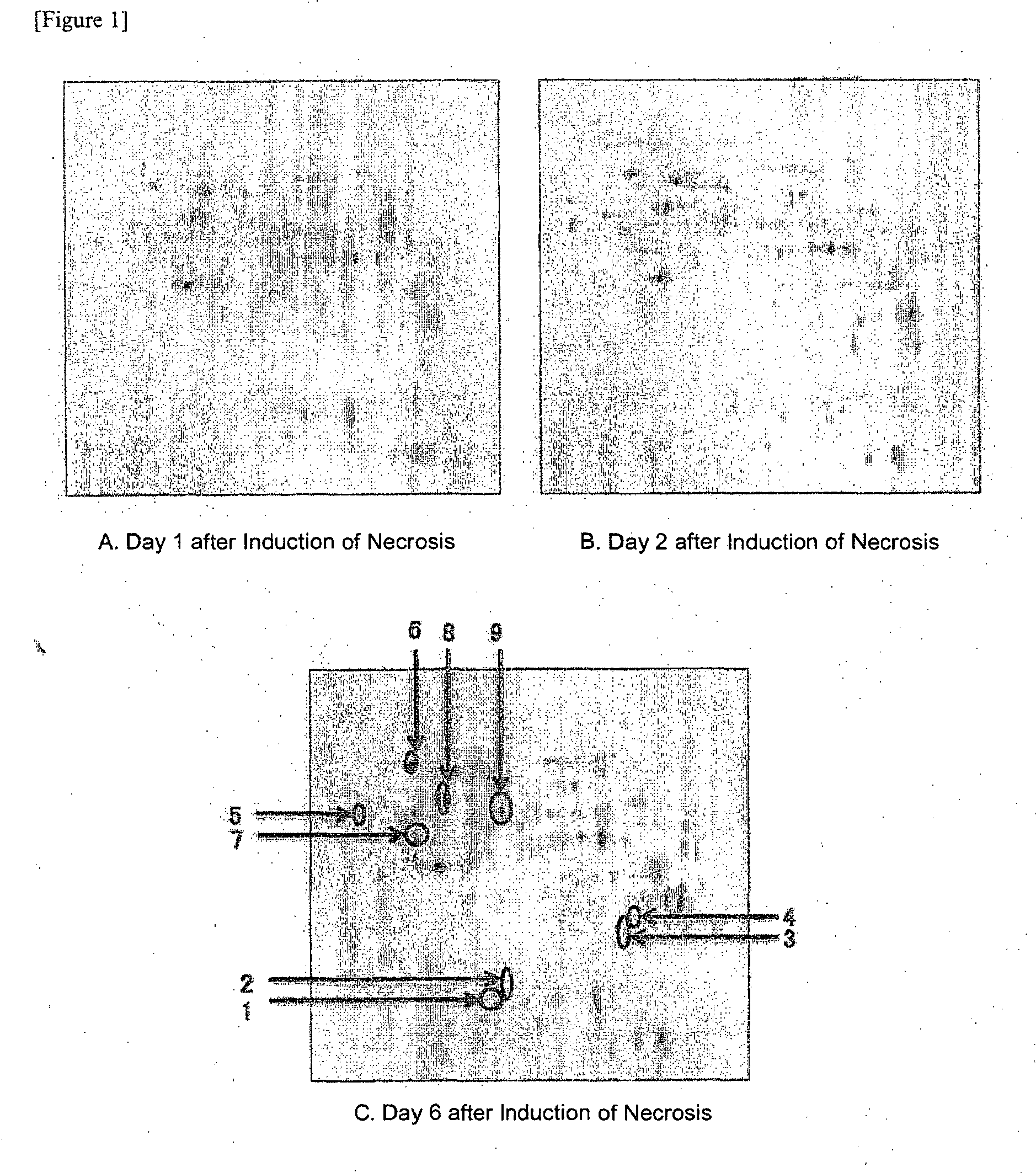 pancreatitis nekrotisierende y diabetes pancreatitis nekrotisierende y diabetes