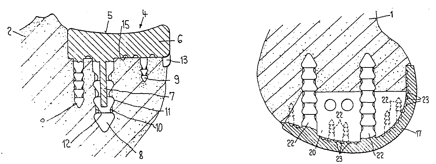 knee joint slide prosthesis
