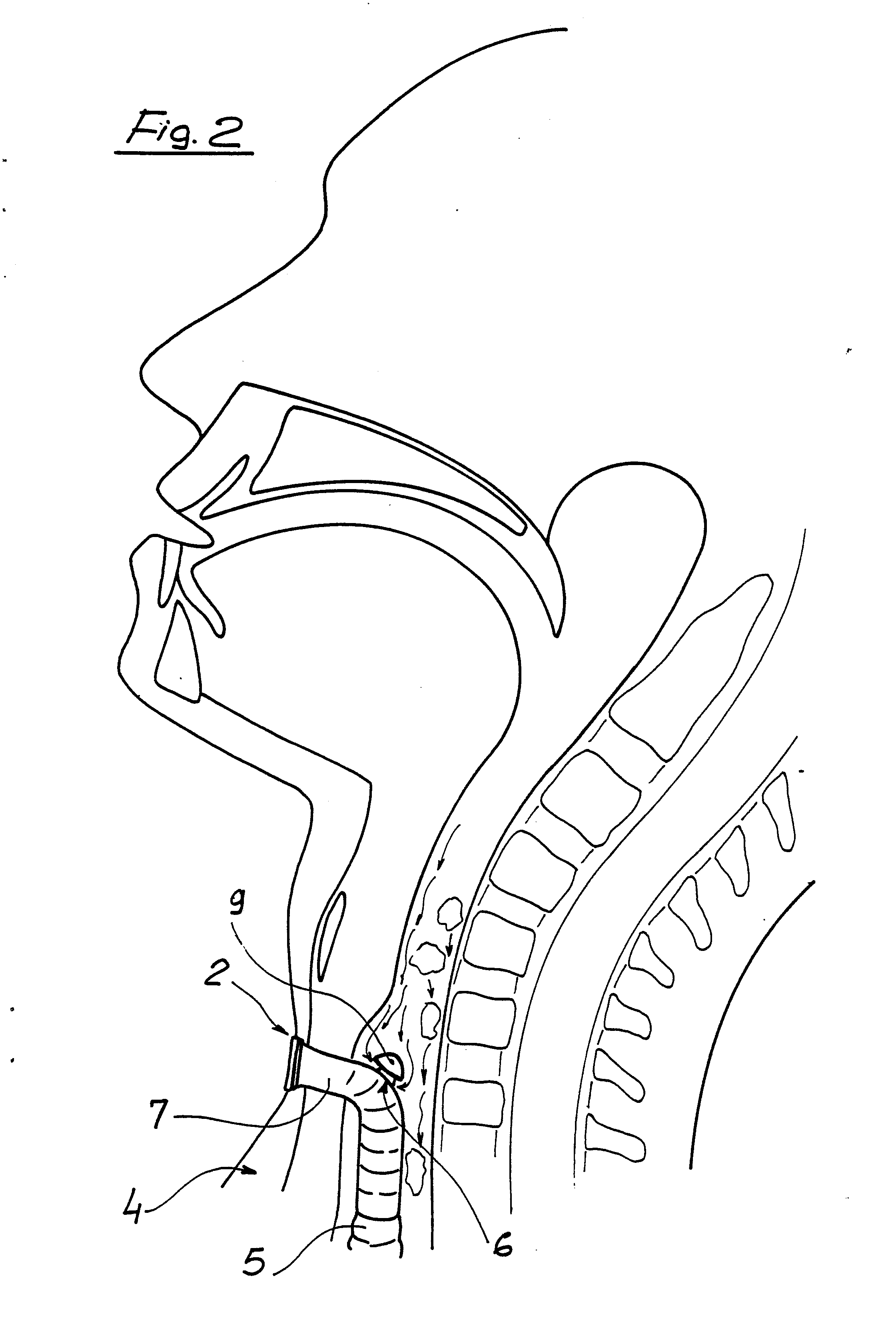 phonation valve for laryngectomy patients