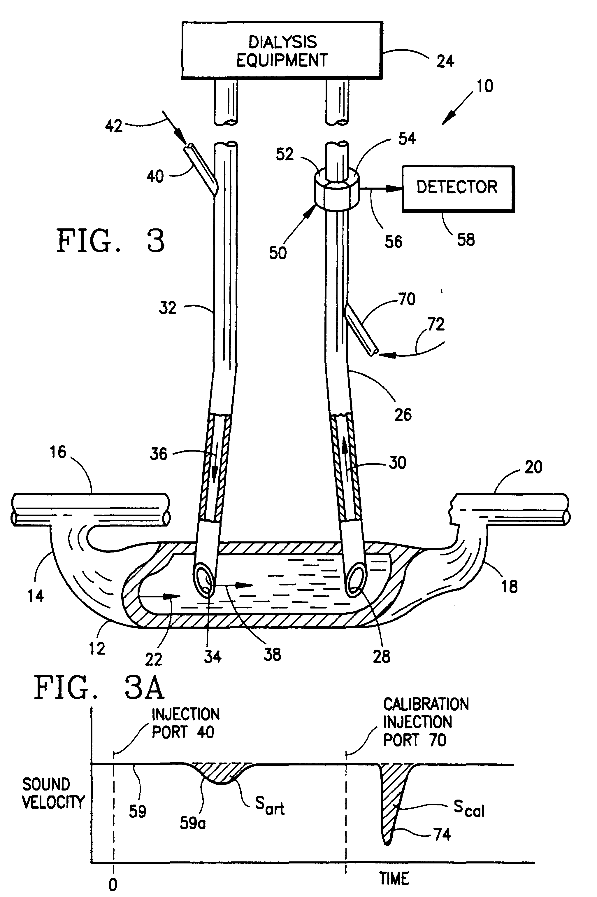 blood flow measurement method in hemodialysis shunts
