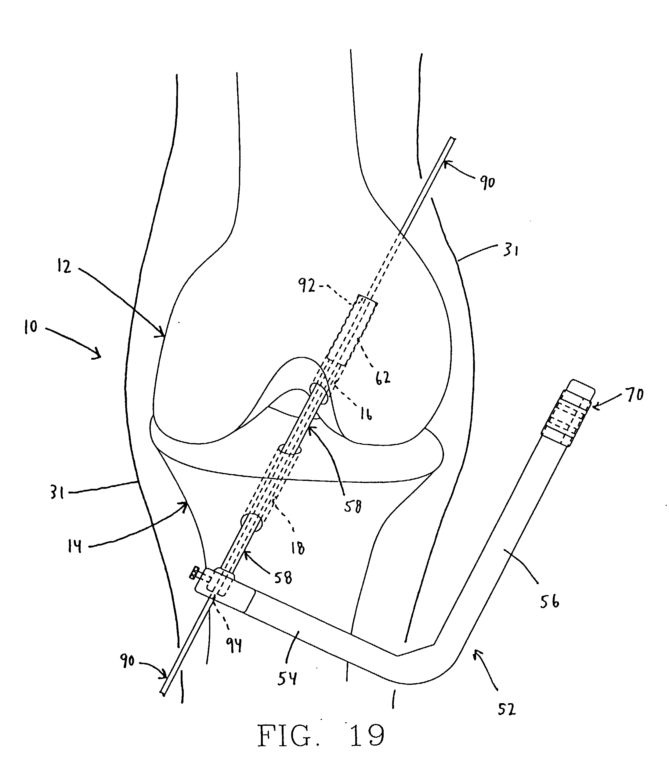 apparatus for fixing a graft in a bone tunnel