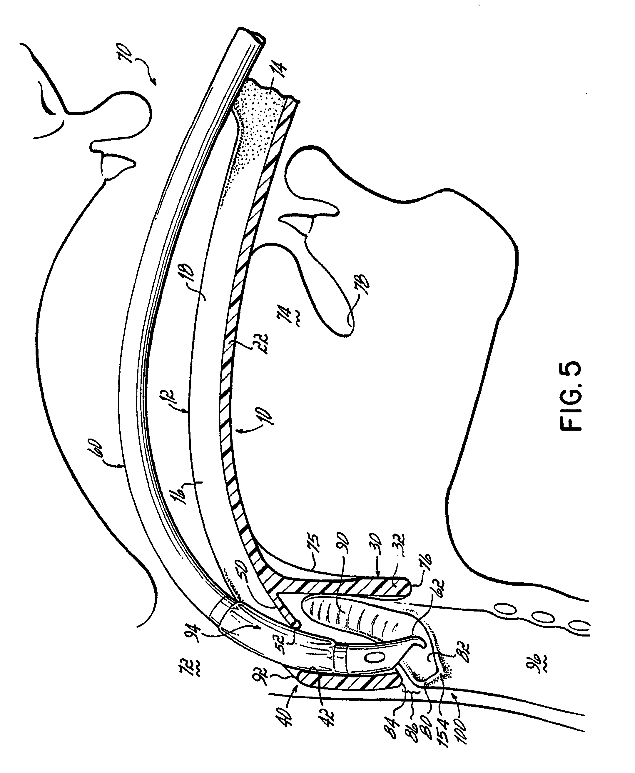 orotracheal intubation guide