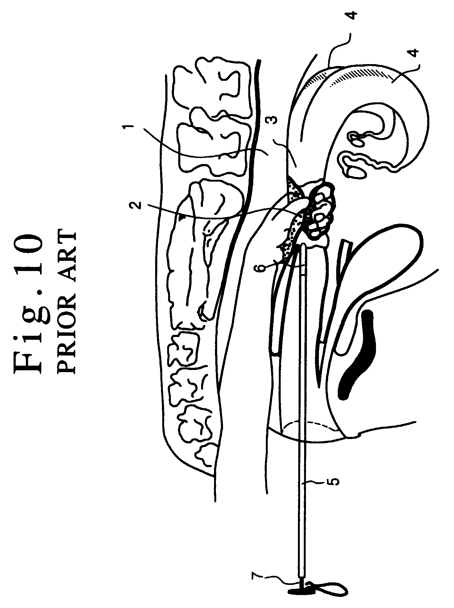 injector of sperm or of a fertilized ovum into a domestic animal