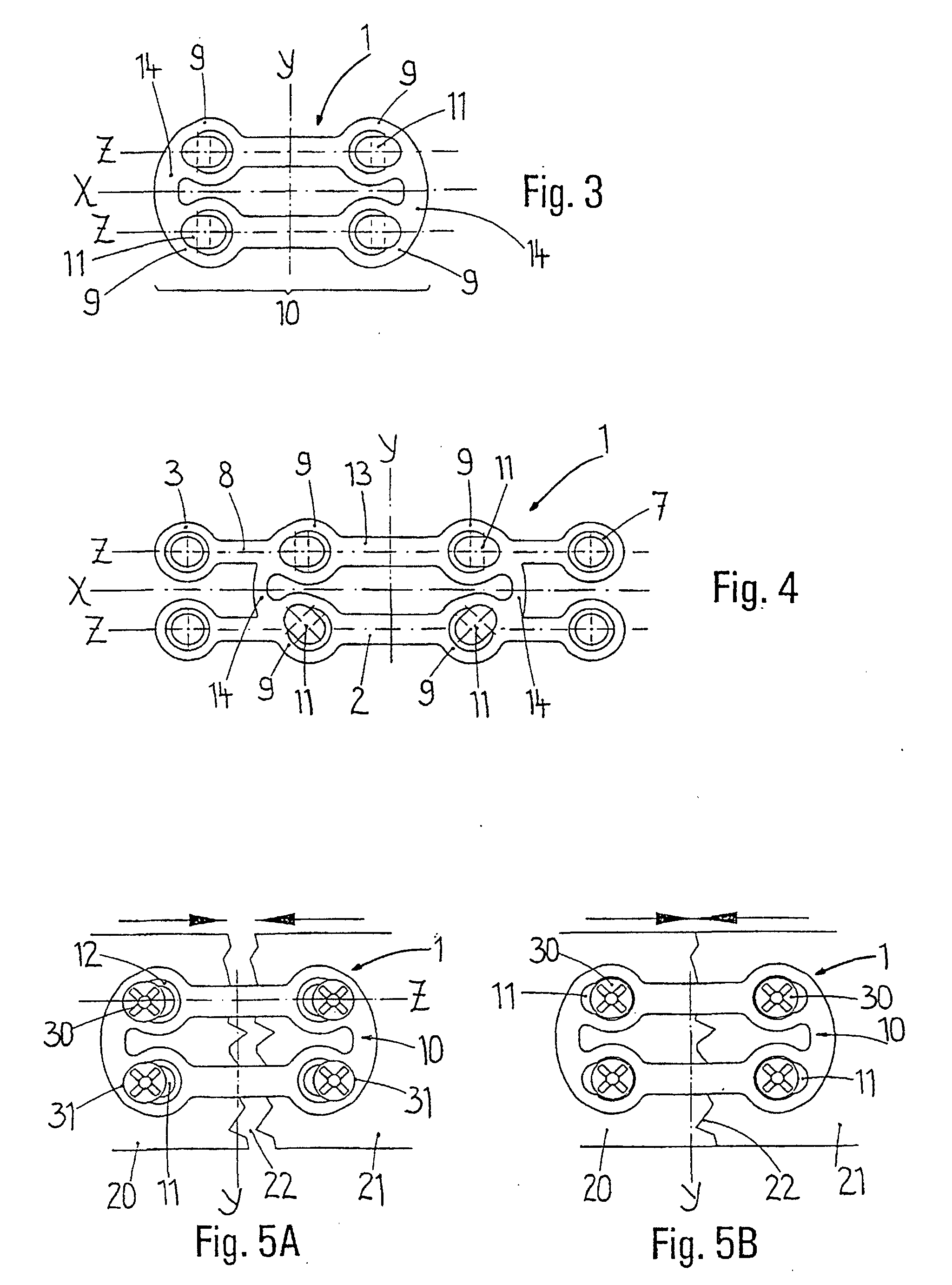 Treatment of mandibular fractures by means of compression osteosynthesis