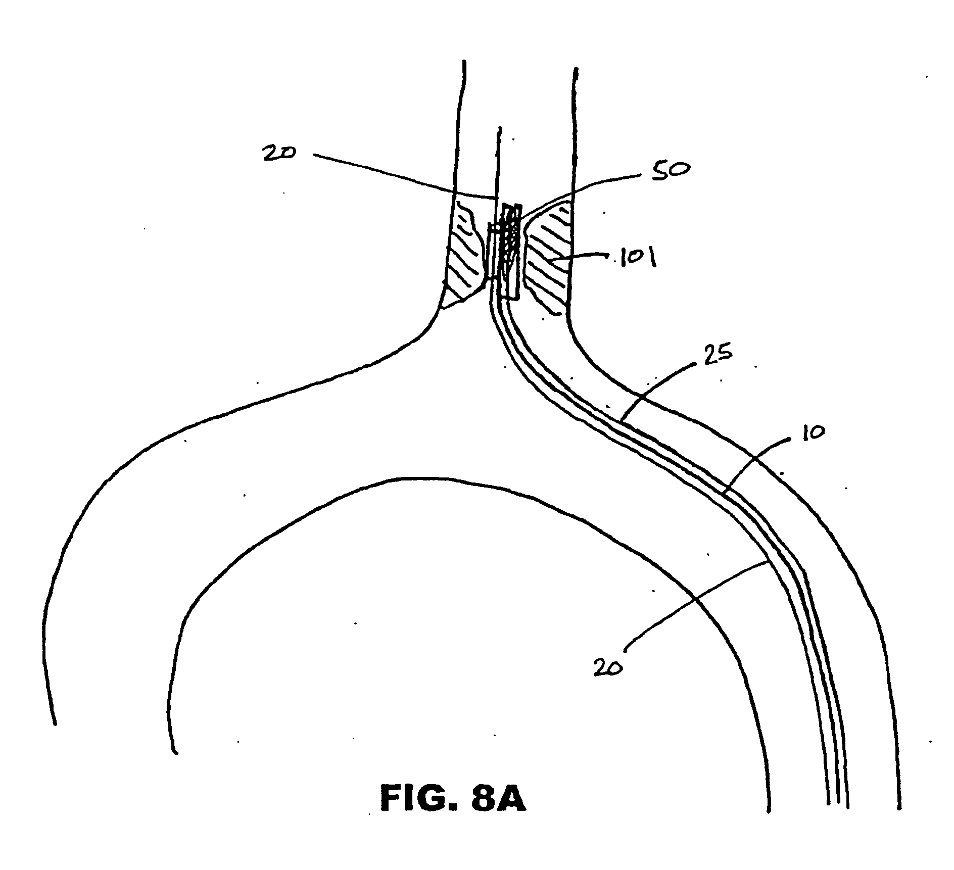 rapid exchange catheter sheath for deployment of medical devices