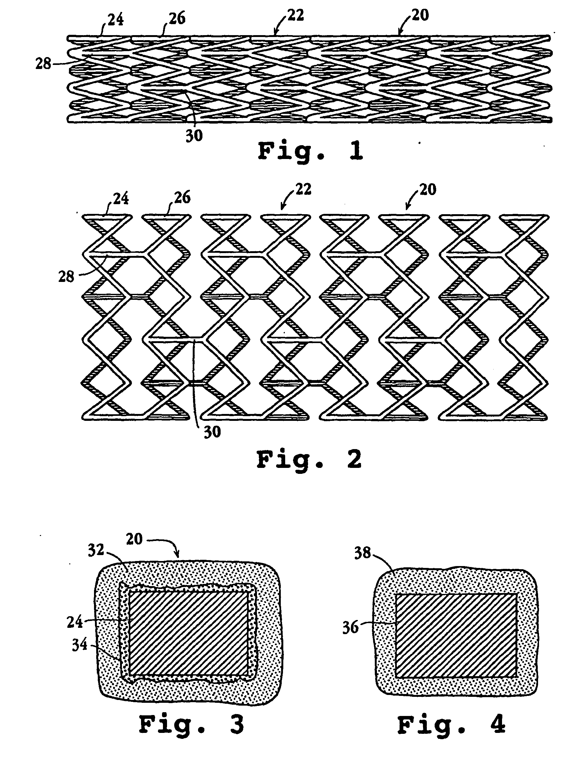 Icd 10 Code For Hx Of Cad With Stent Placement