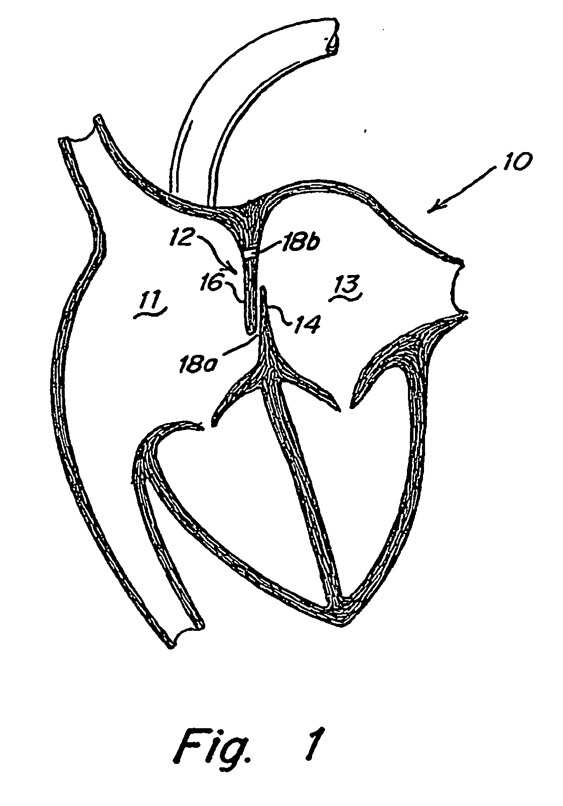 tubular patent foramen ovale (pfo) closure device with catch