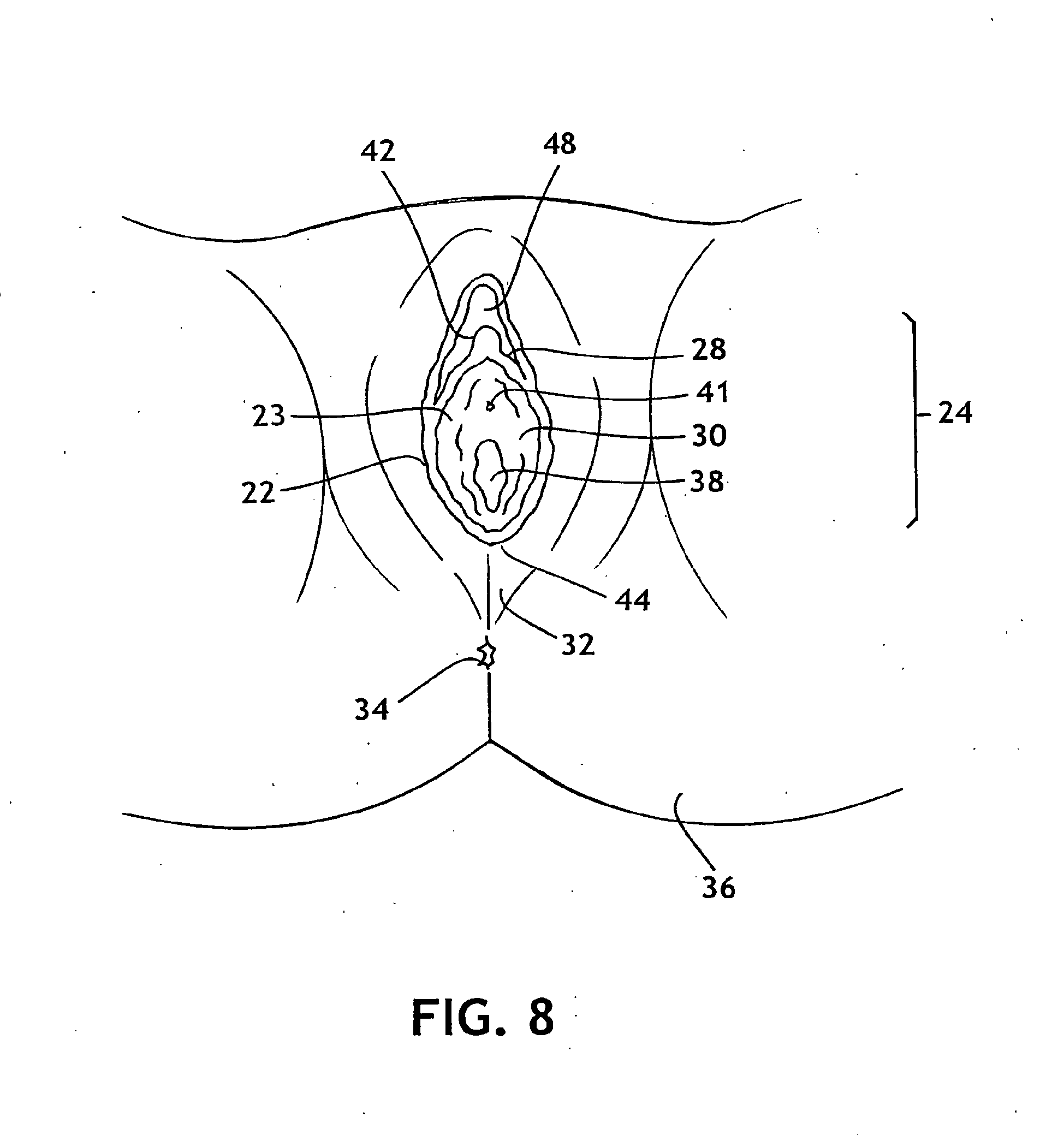 bodily exudate capturing article
