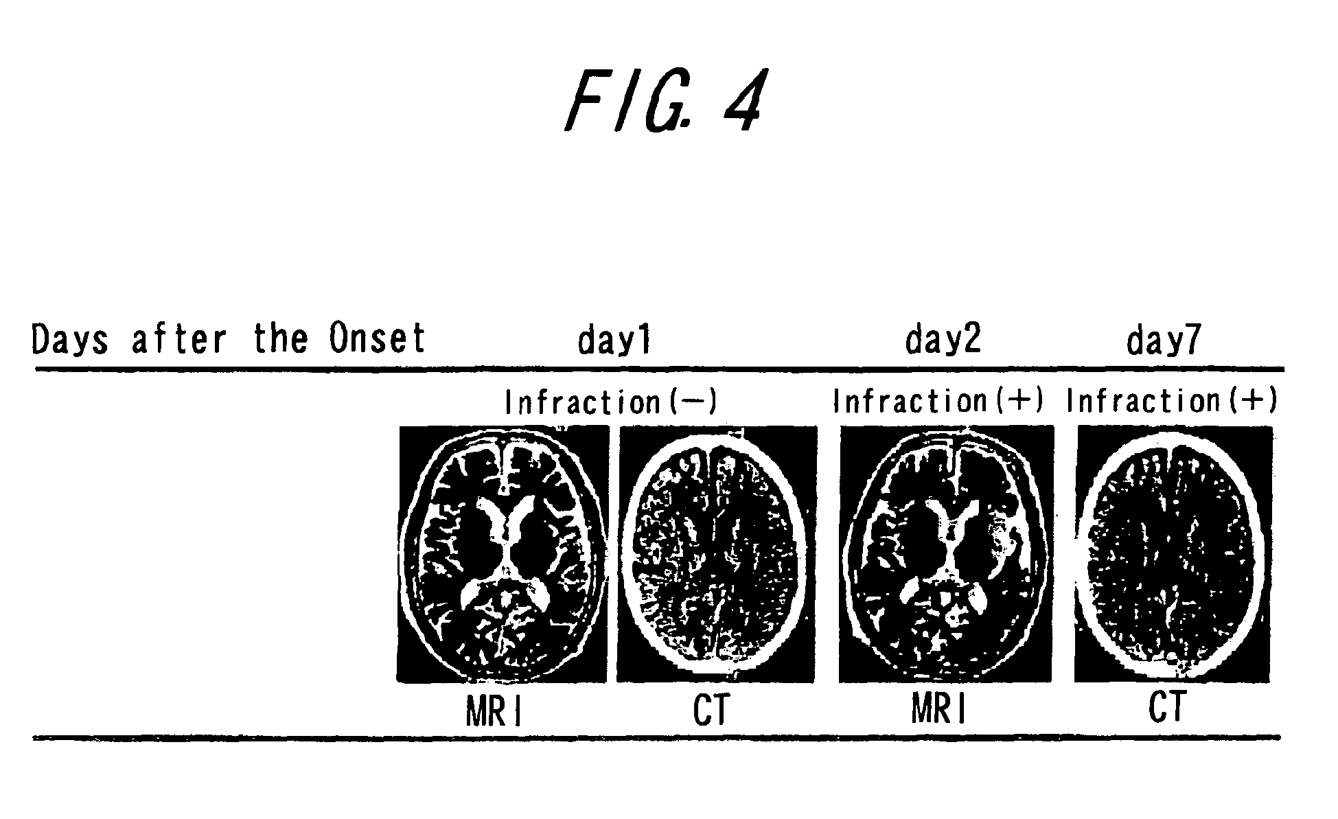 method of diagnosing apoplectic stroke/asymptomatic brain