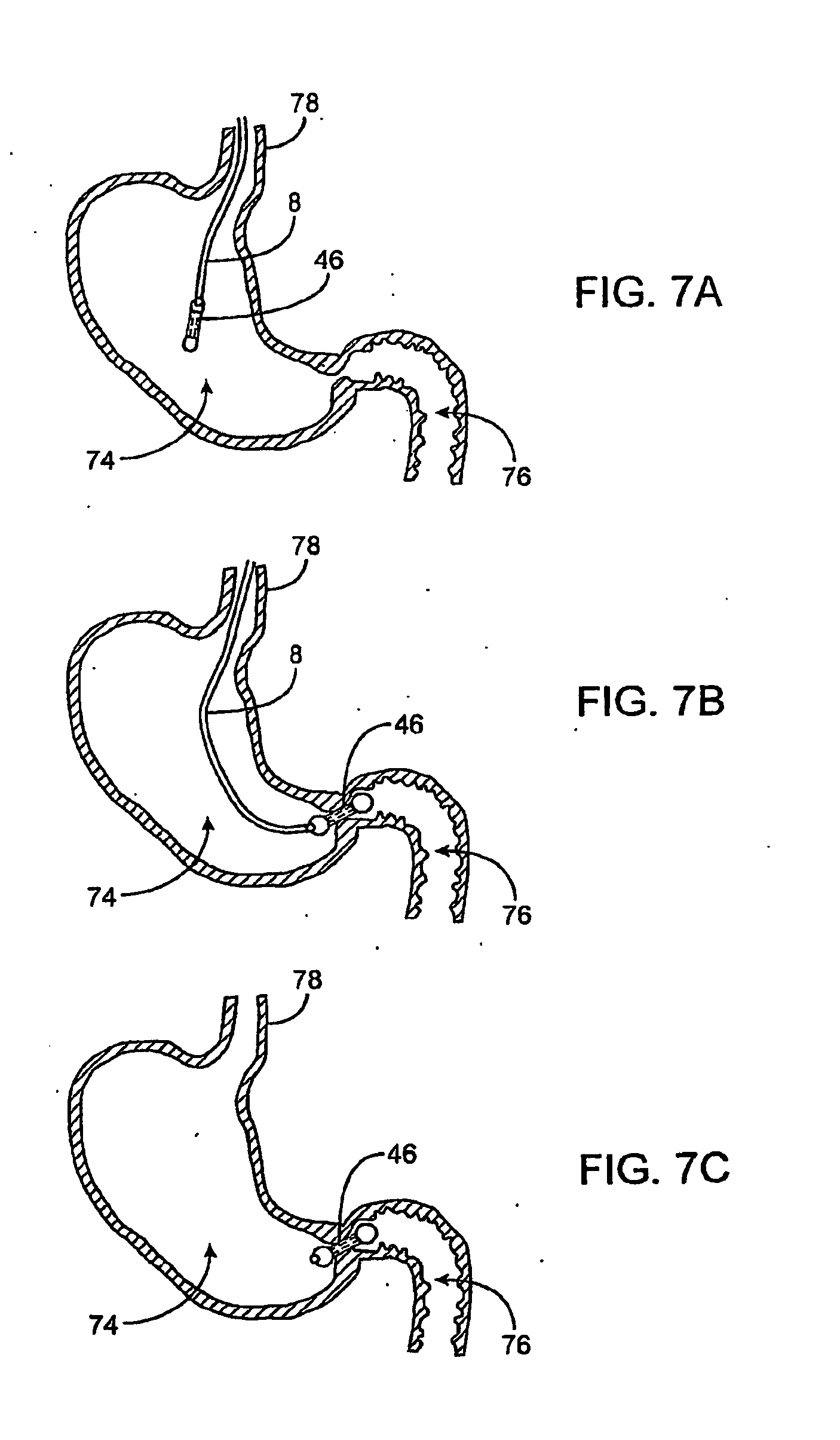 devices for pyloric anchoring