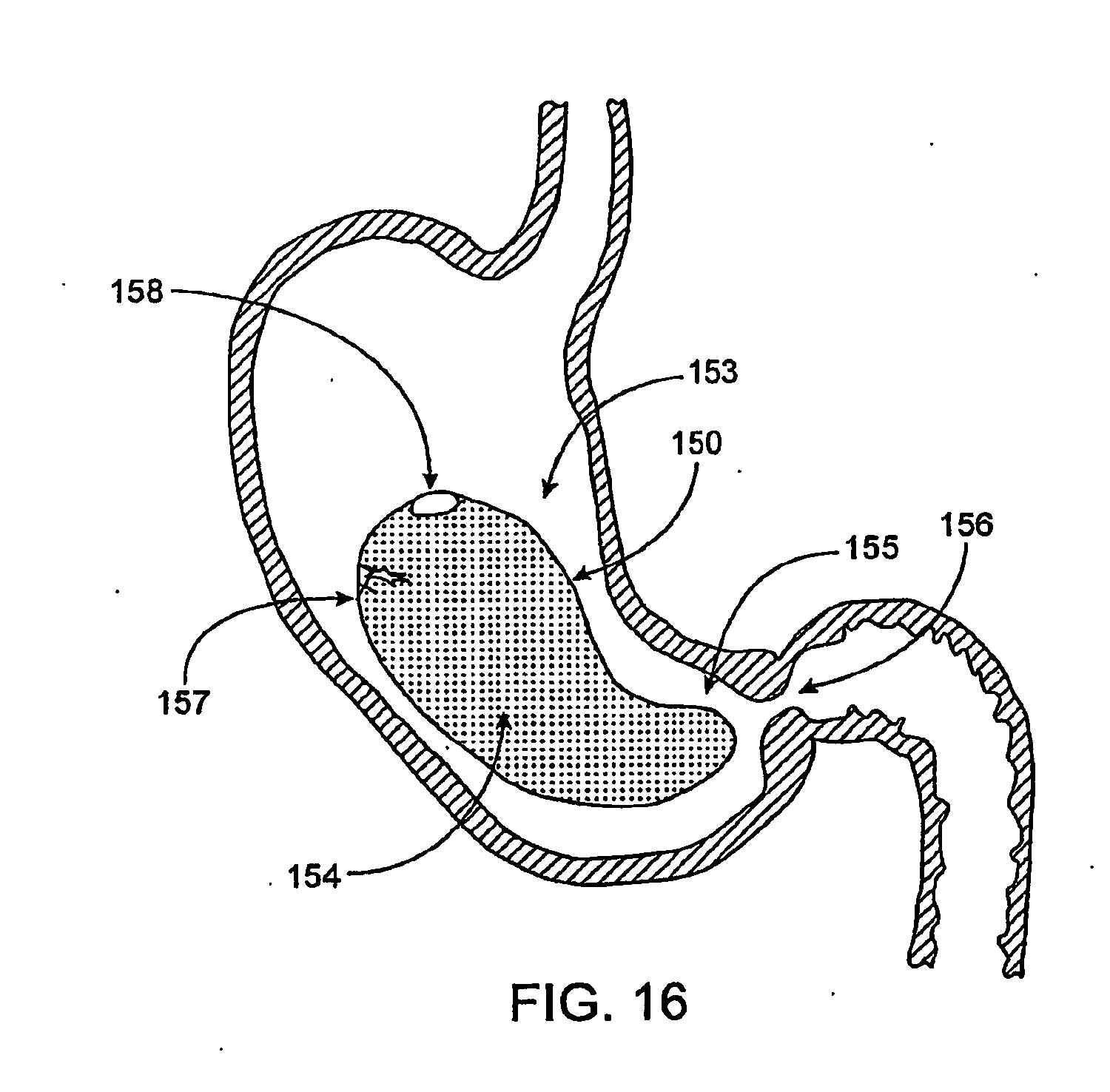 devices for pyloric anchoring