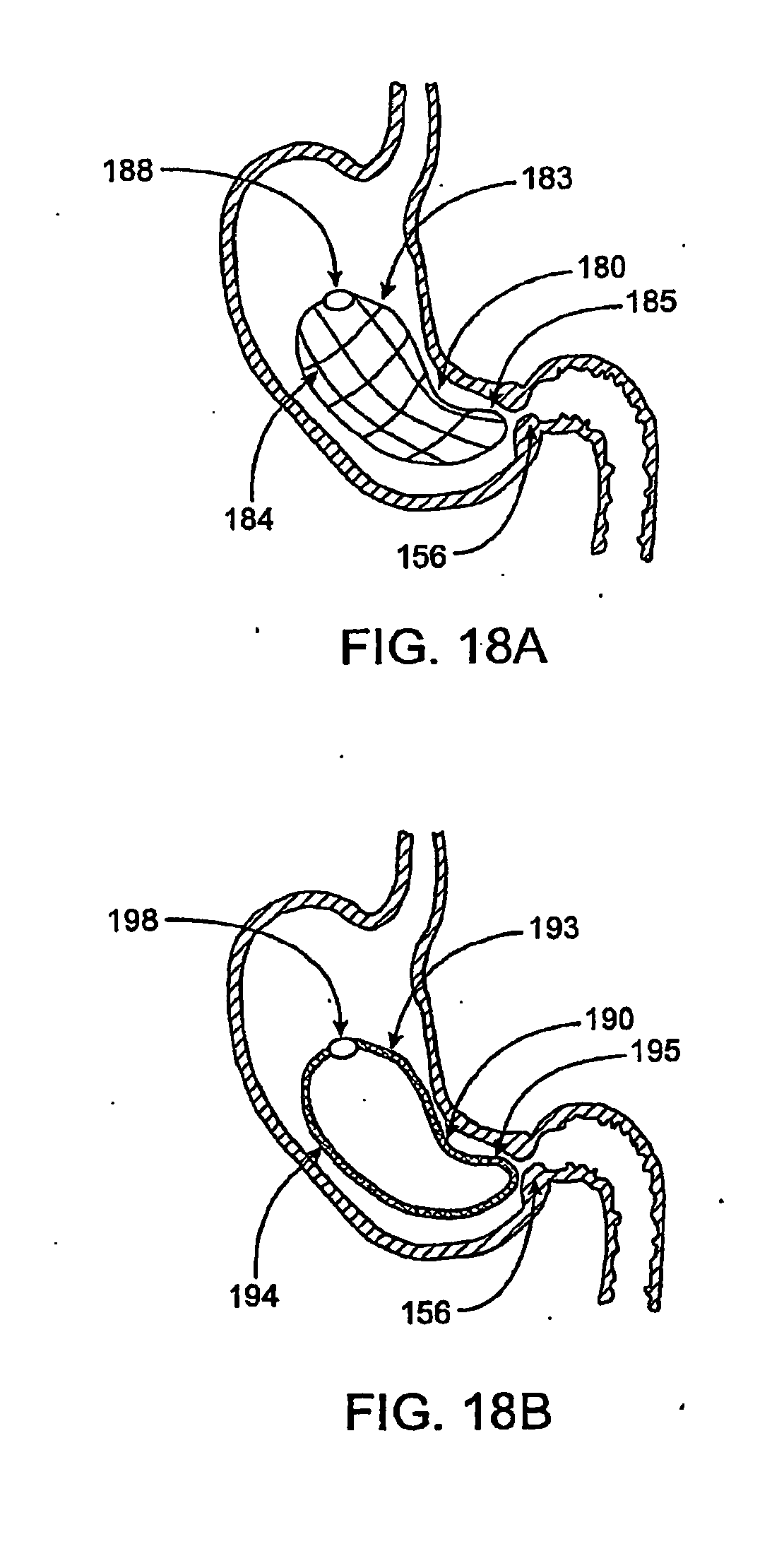devices for pyloric anchoring