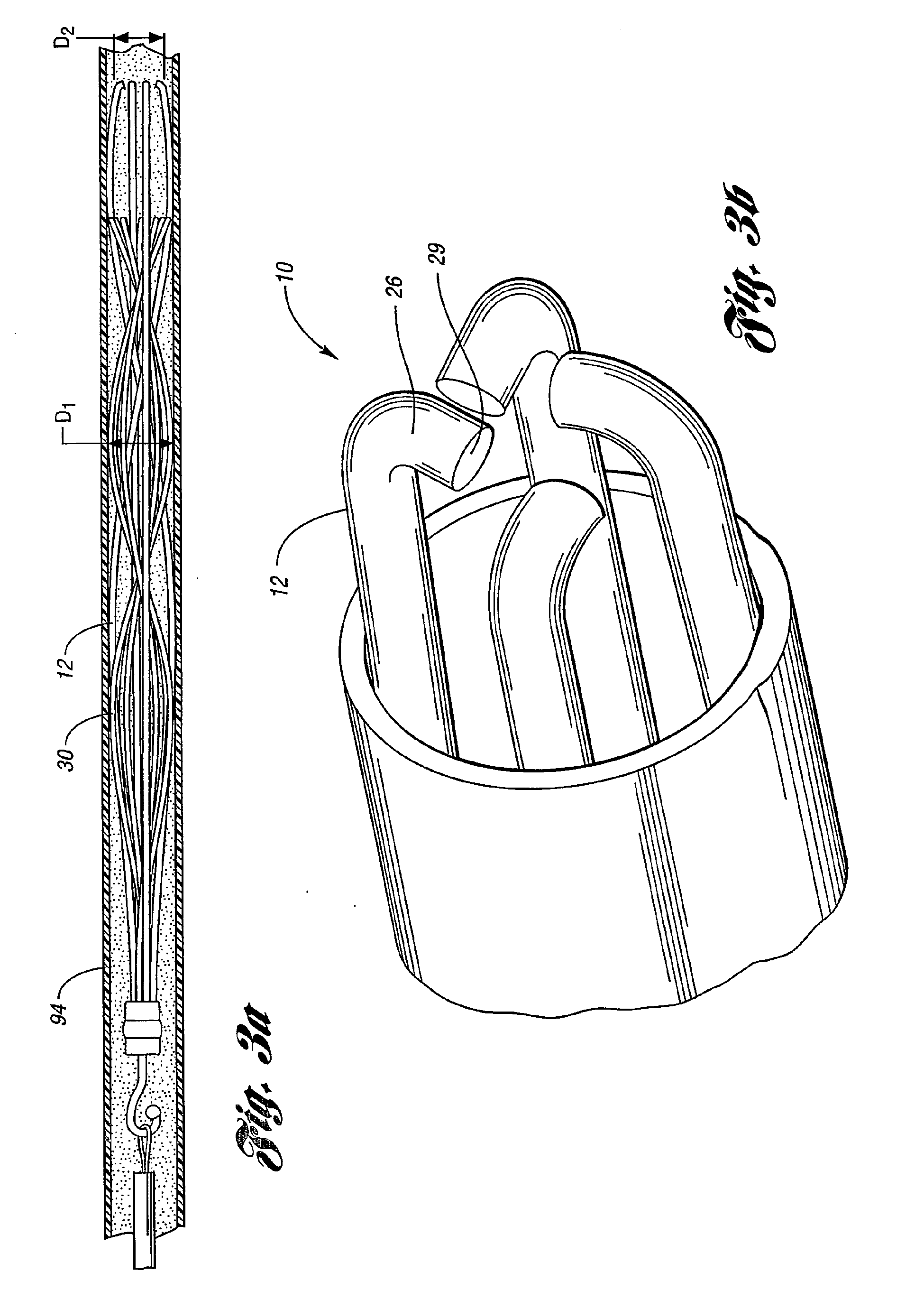 filtre amovible pour veine cave