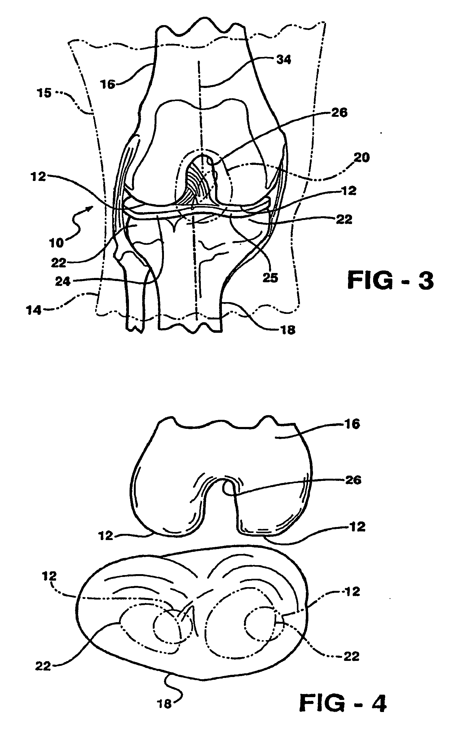 knee brace and methods of use and modification thereof
