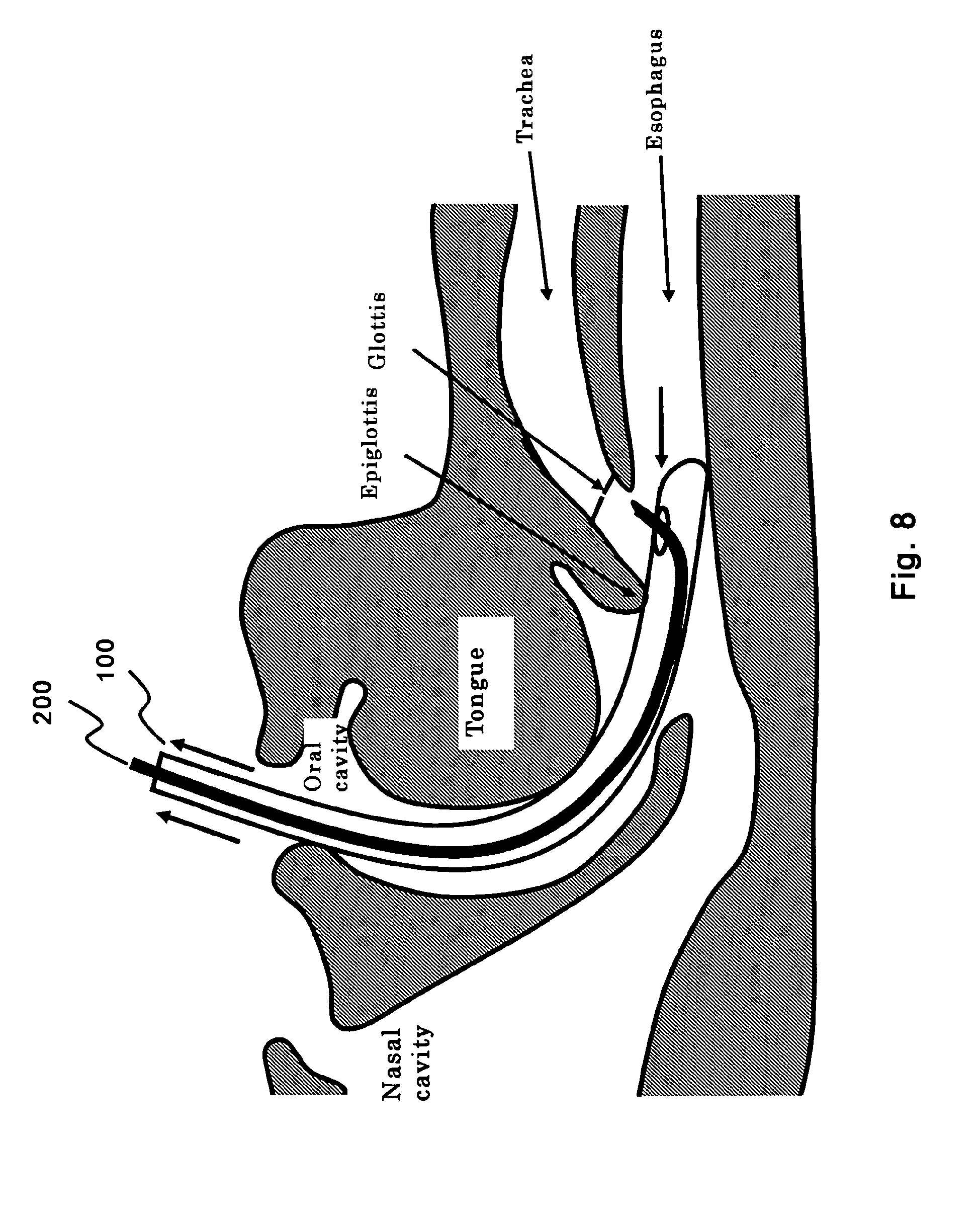 endotracheal tube insertion assist instrument