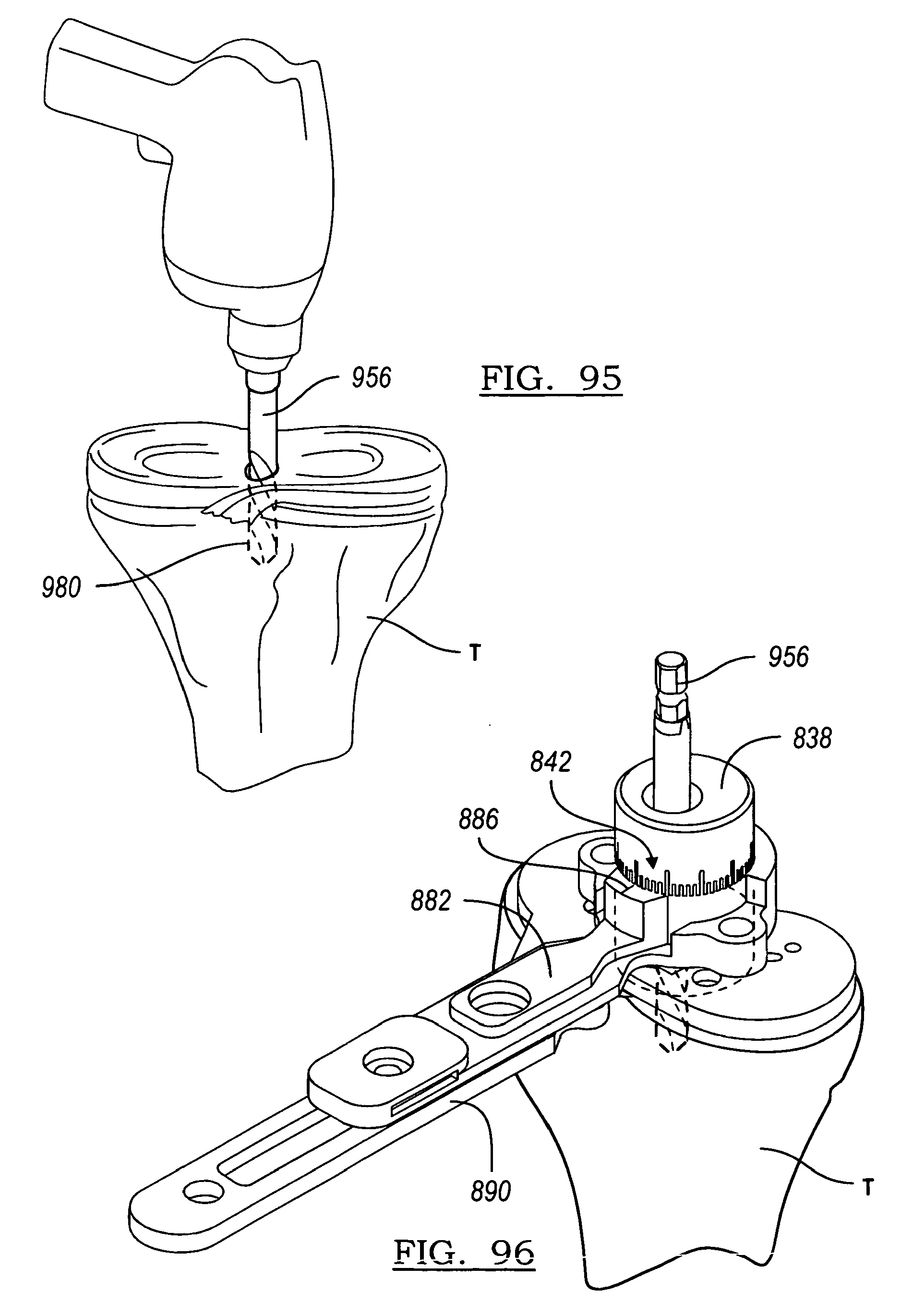 knee joint prosthesis system