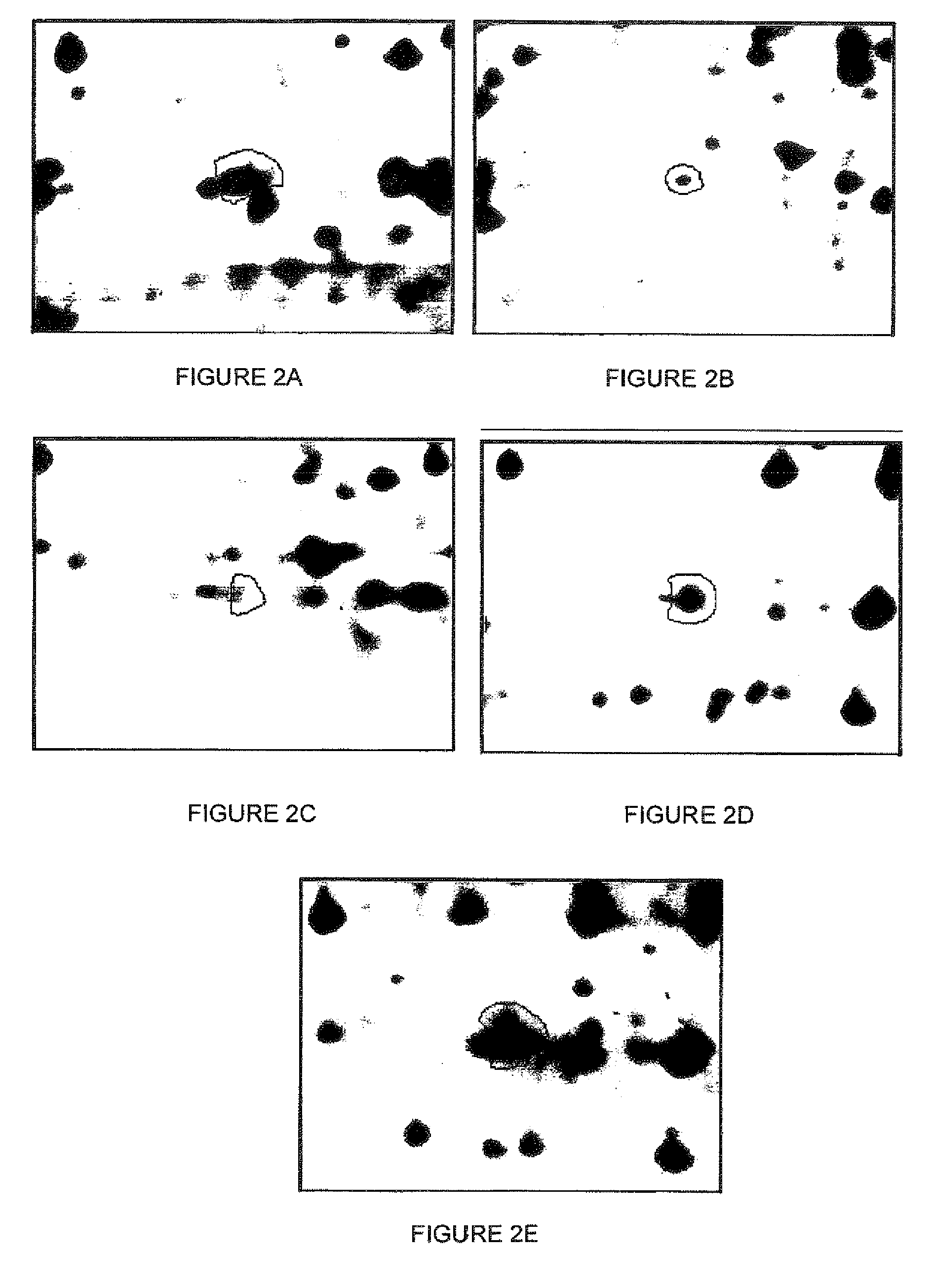non-invasive in vitro method to detect transitional cell