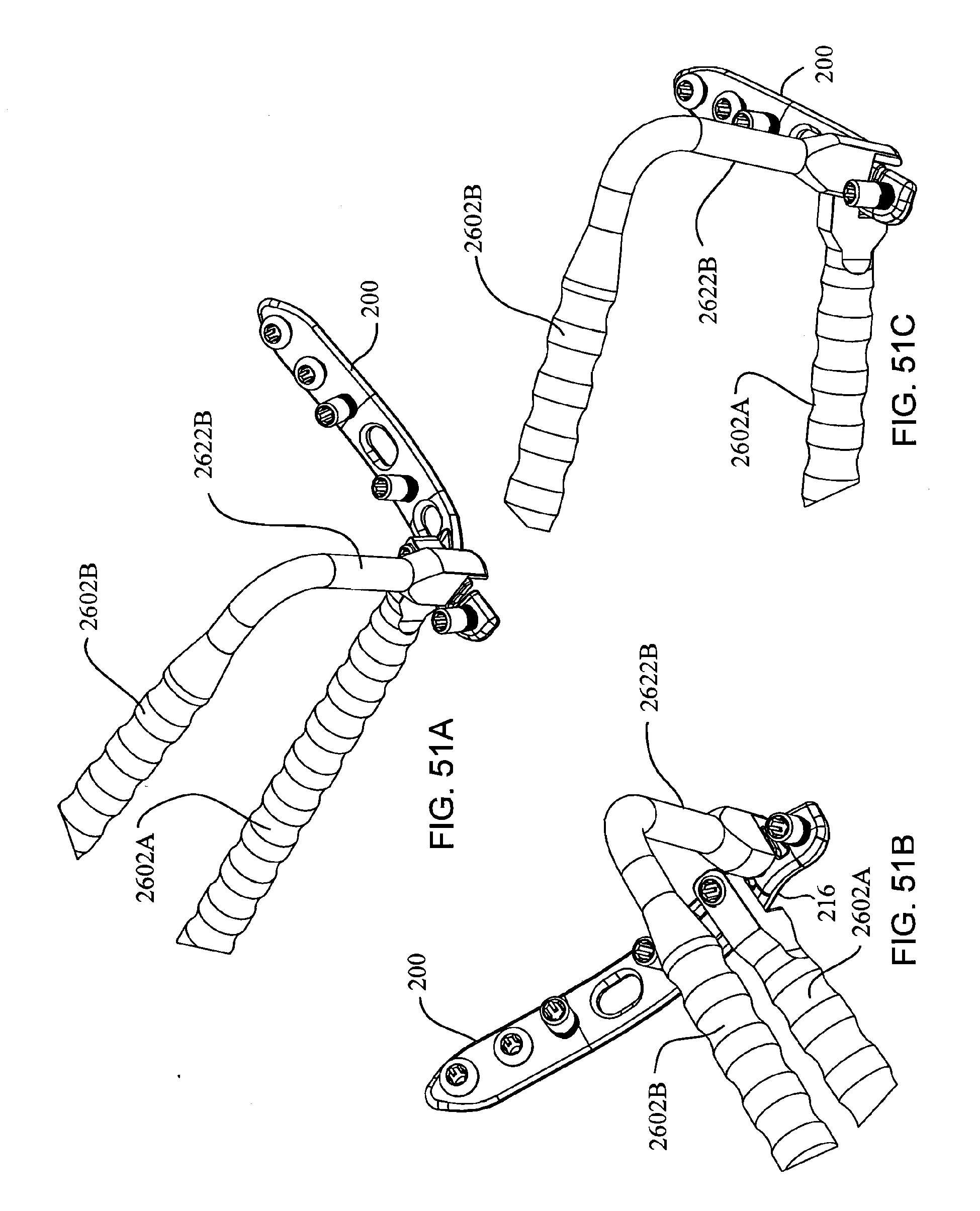 elbow fracture fixation system