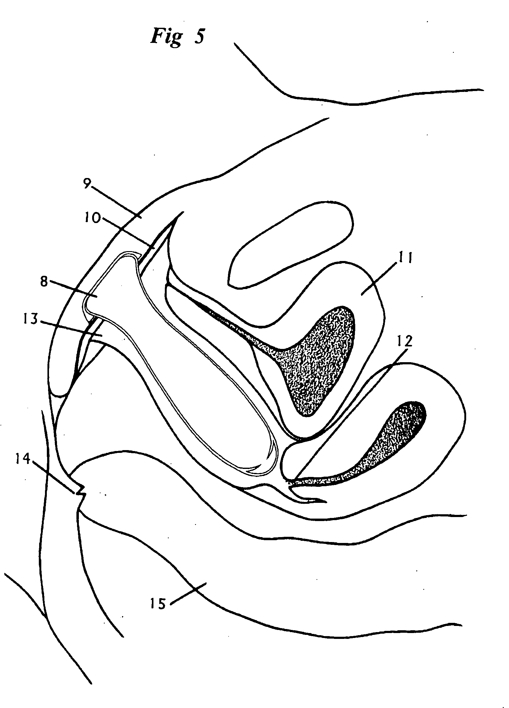 8 coital alignment technique 8 coital alignment technique