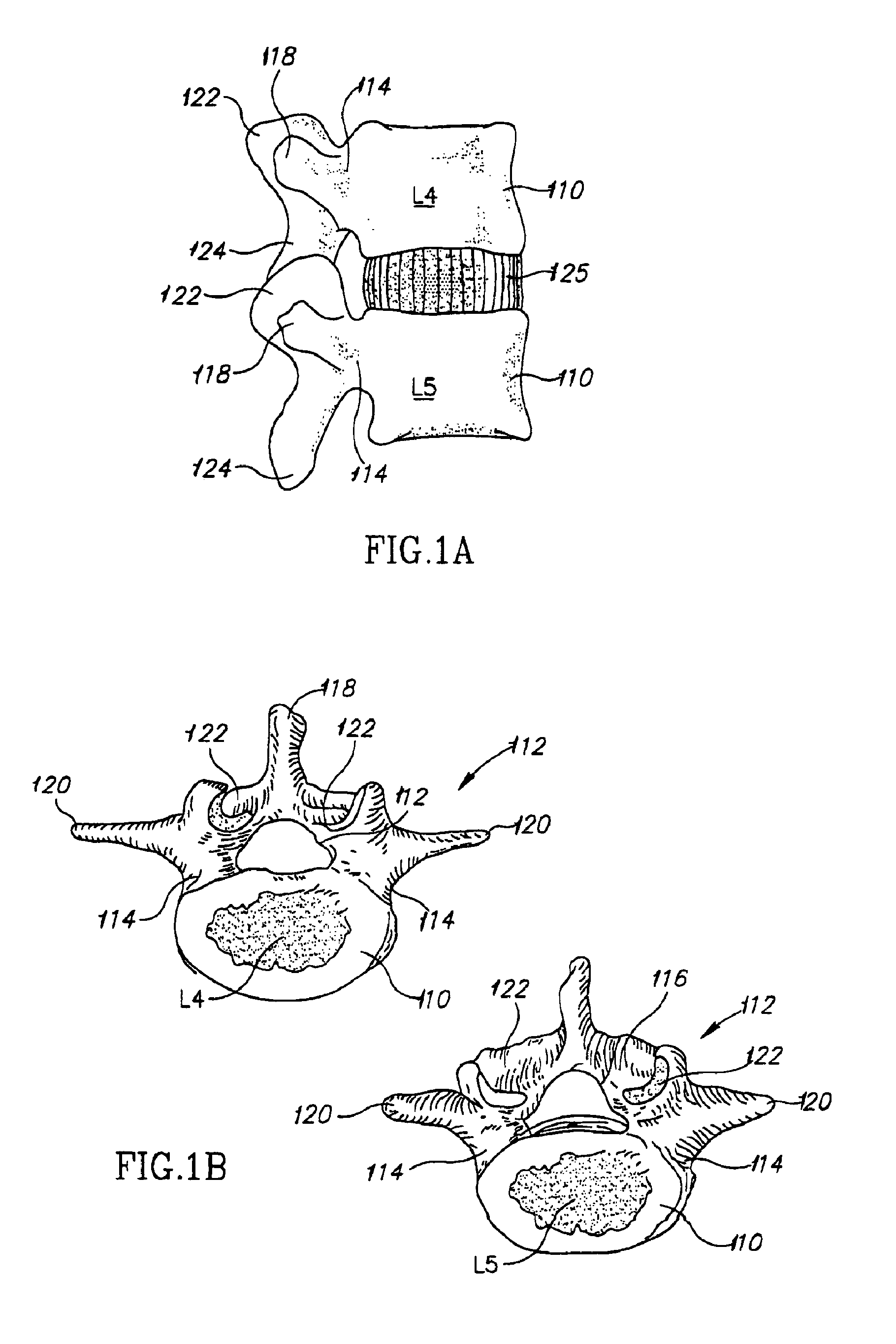spinous prothesis spinous prothesis