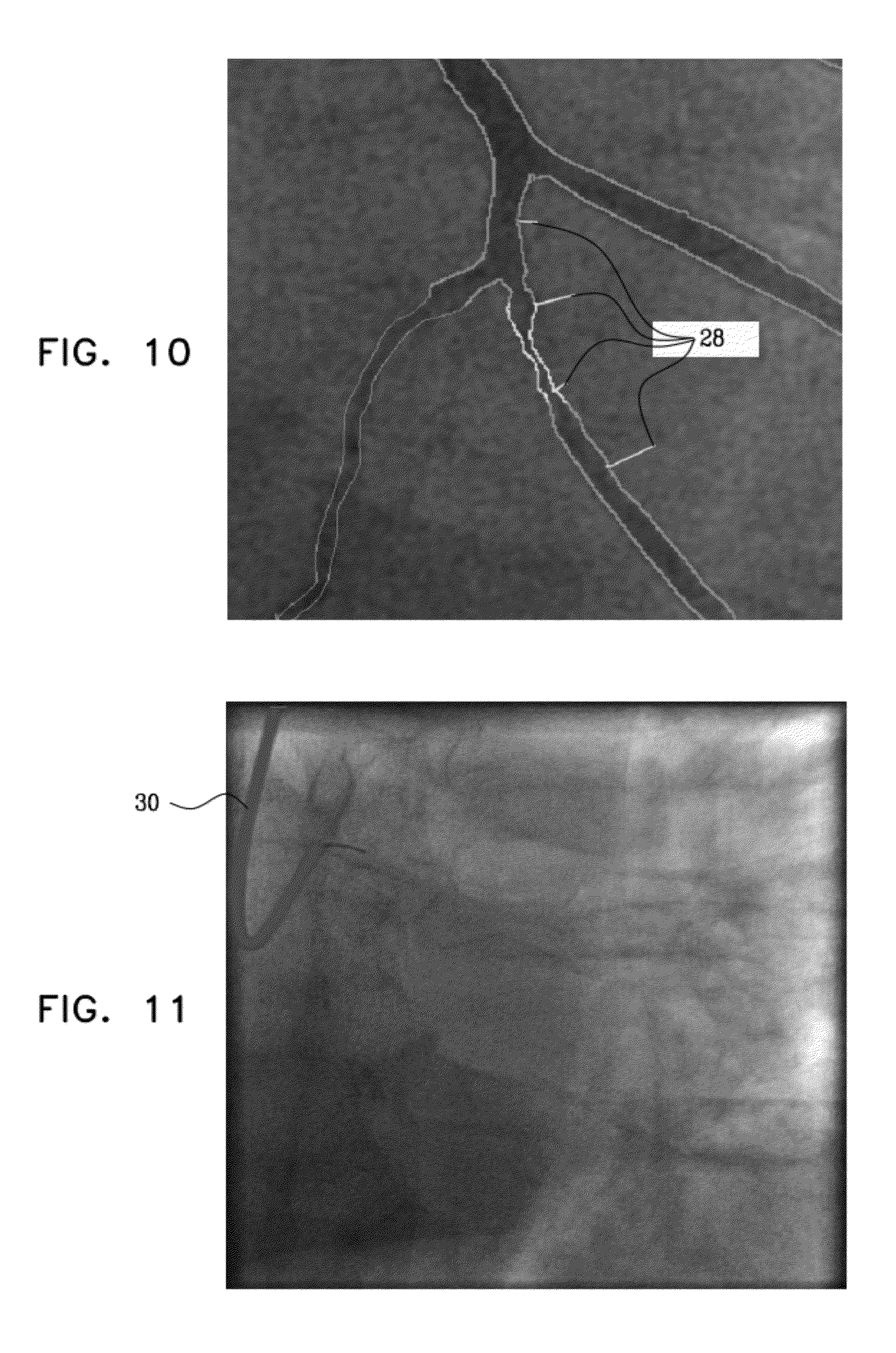 noncompressible calcified vessel meaning noncompressible calcified vessel meaning