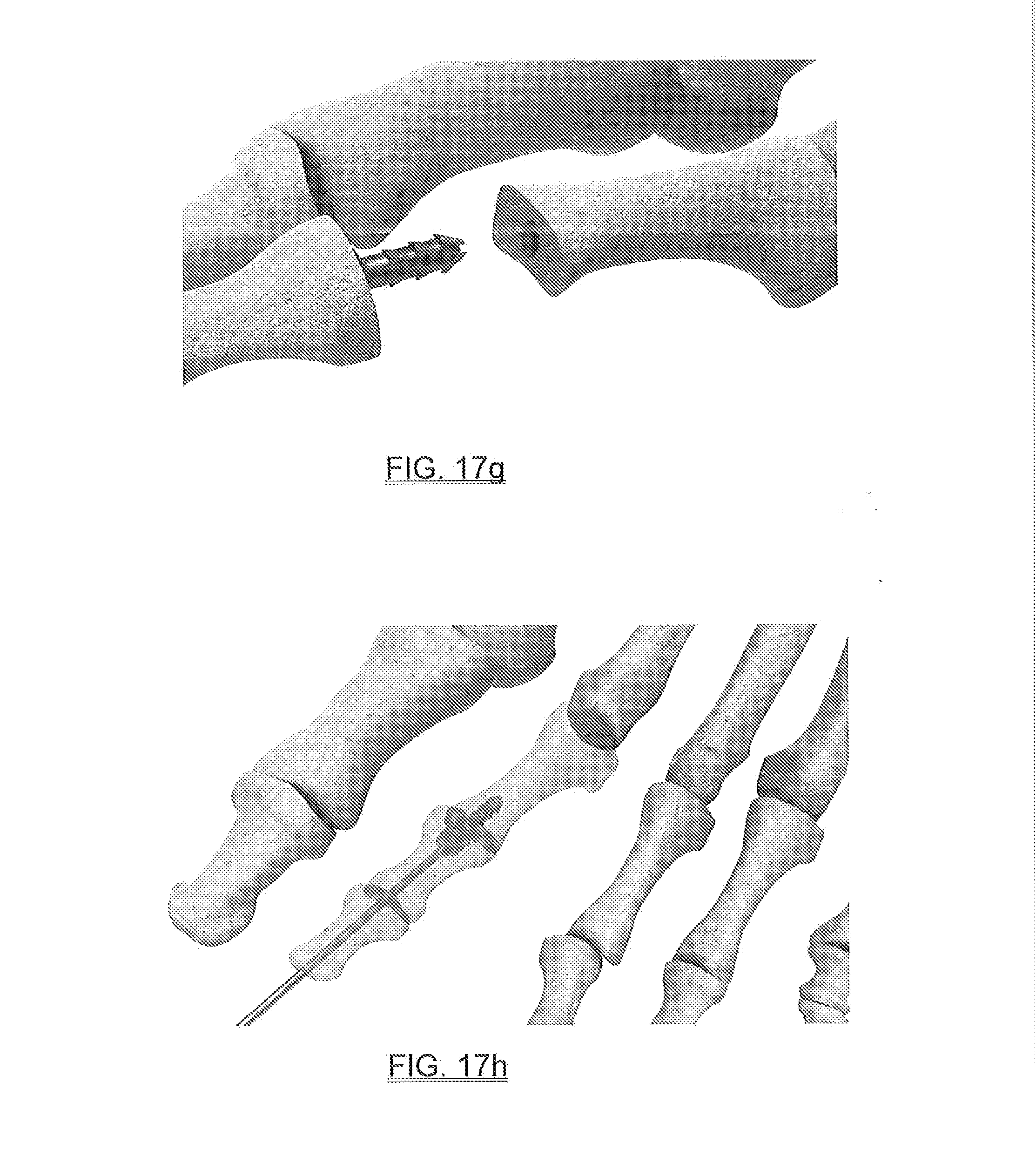 Hammertoe
