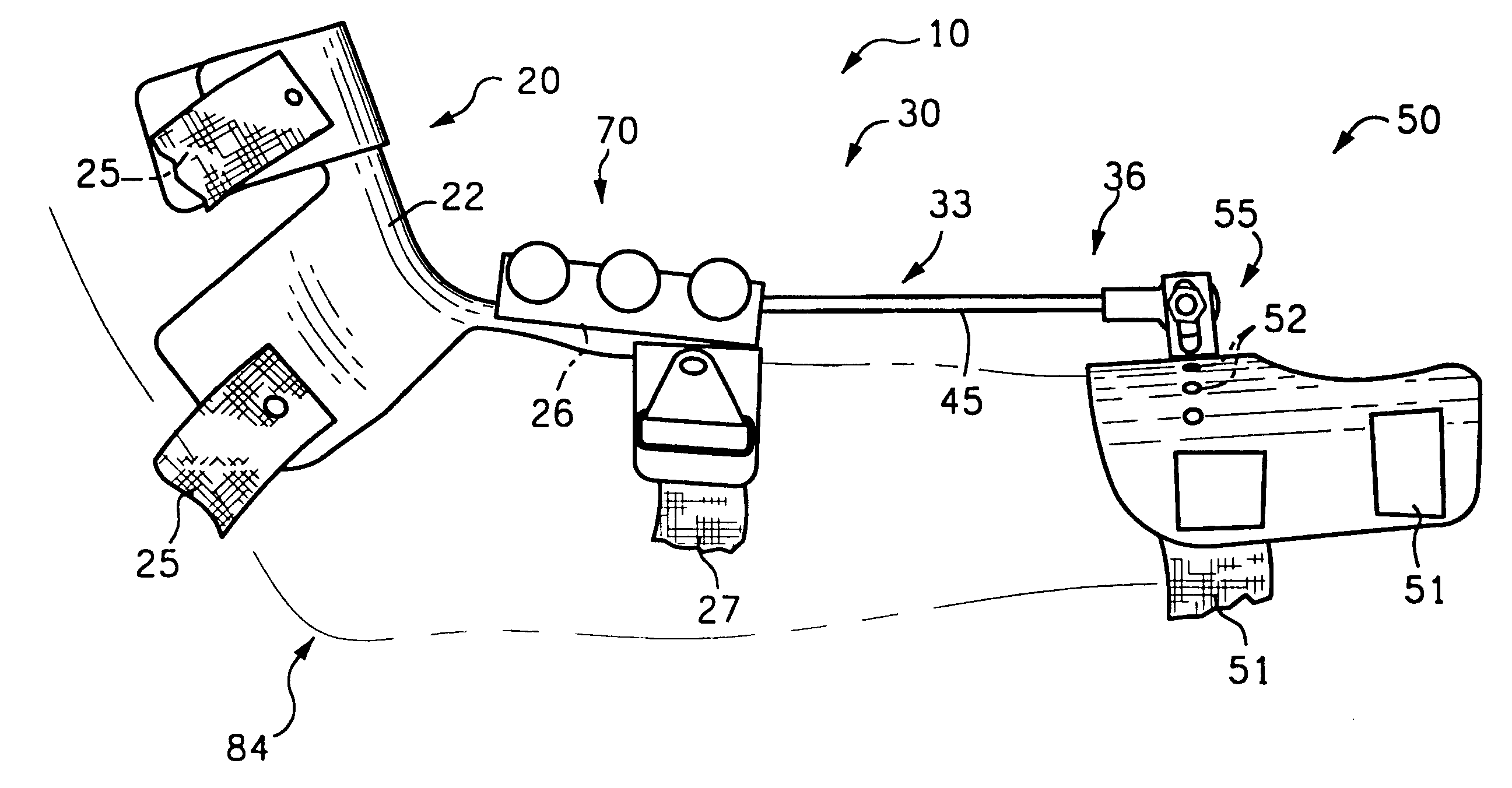 Over Pronation