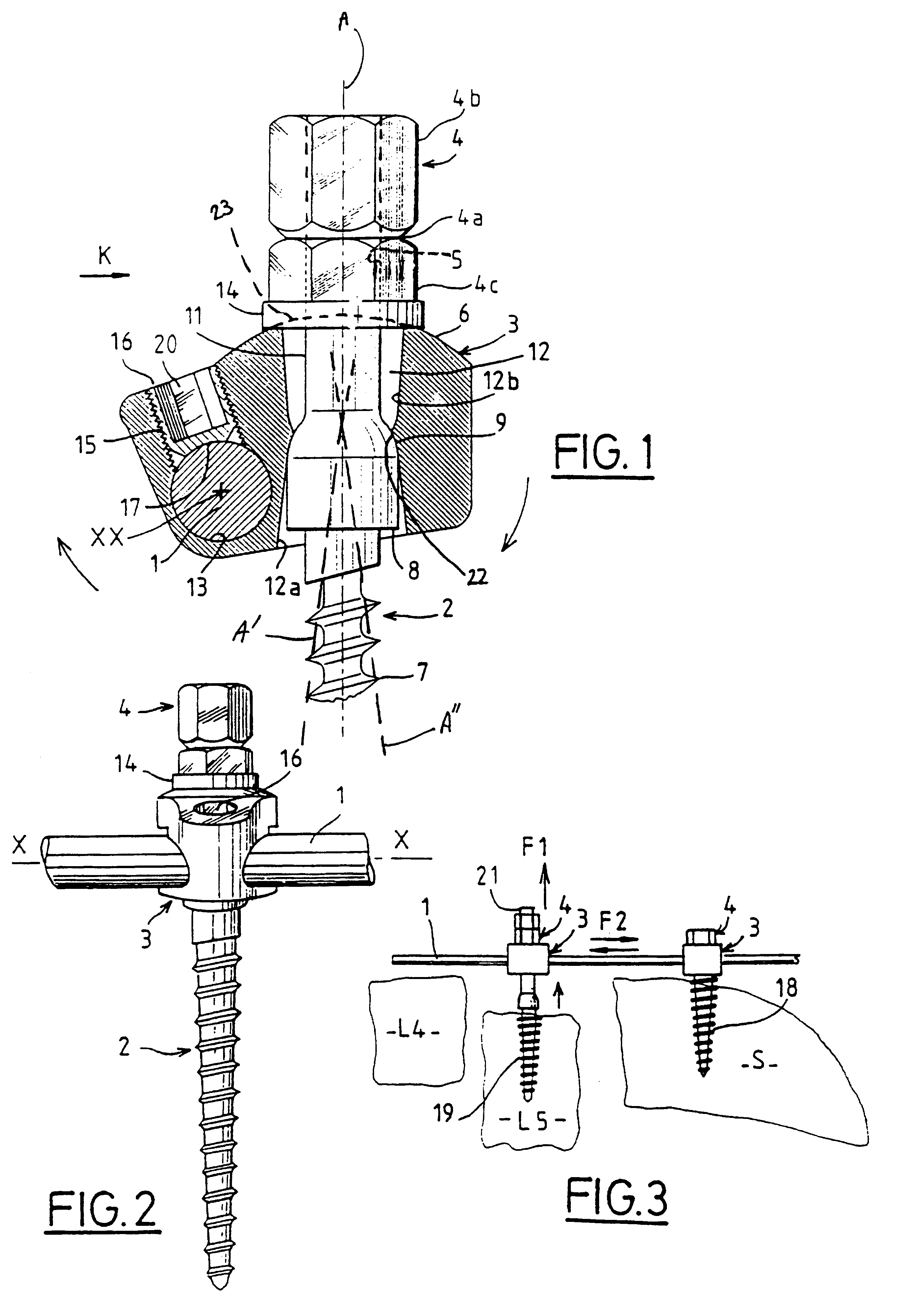 osteosynthesis 2 this publication sets forth detailed recommended procedures for using stryker osteosynthesis devices and instruments it offers guidance that you should. osteosynthesis 2 this publication sets forth detailed recommended procedures for using stryker osteosynthesis devices and instruments it offers guidance that you should.