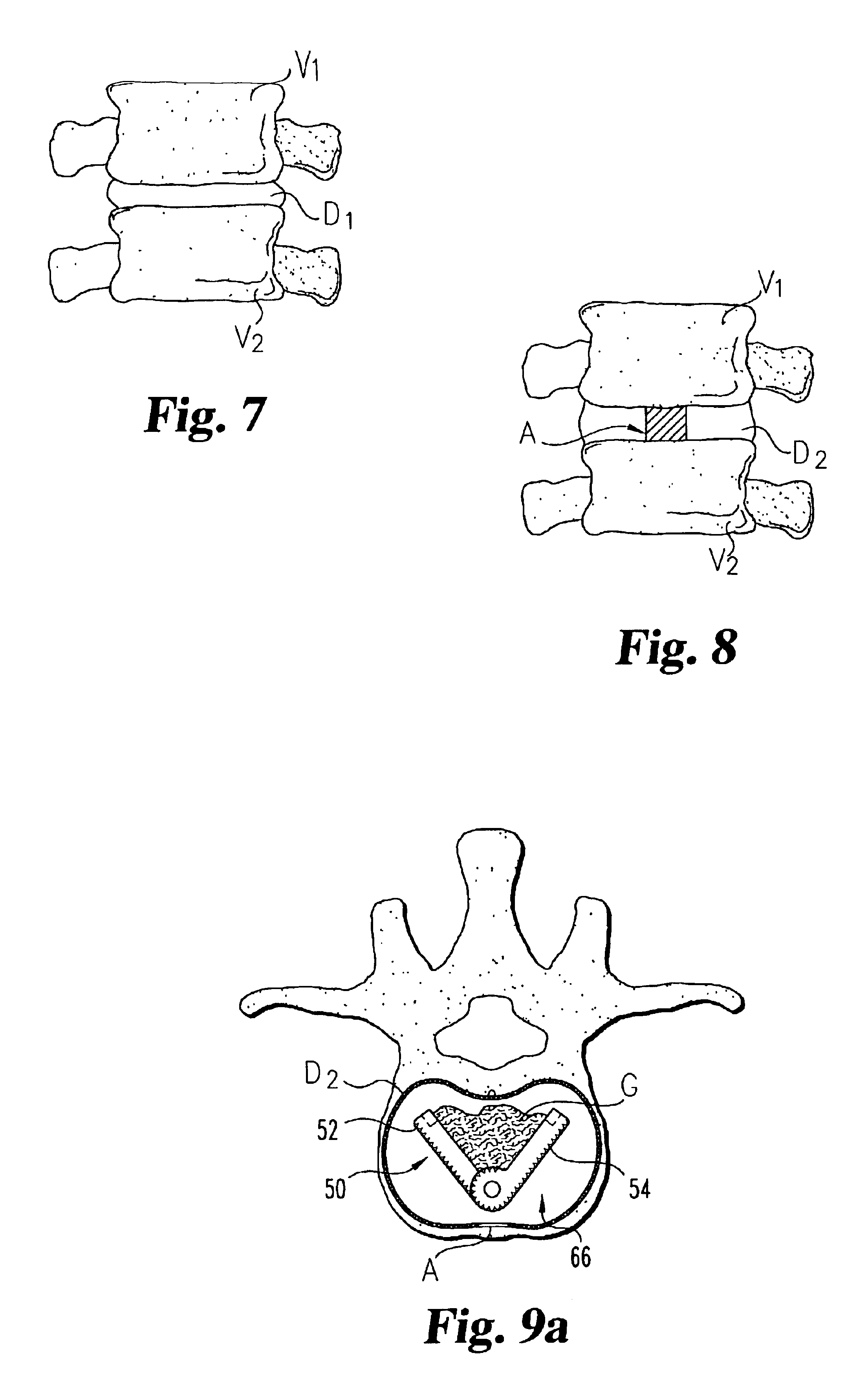 expandable intervertebral spacers