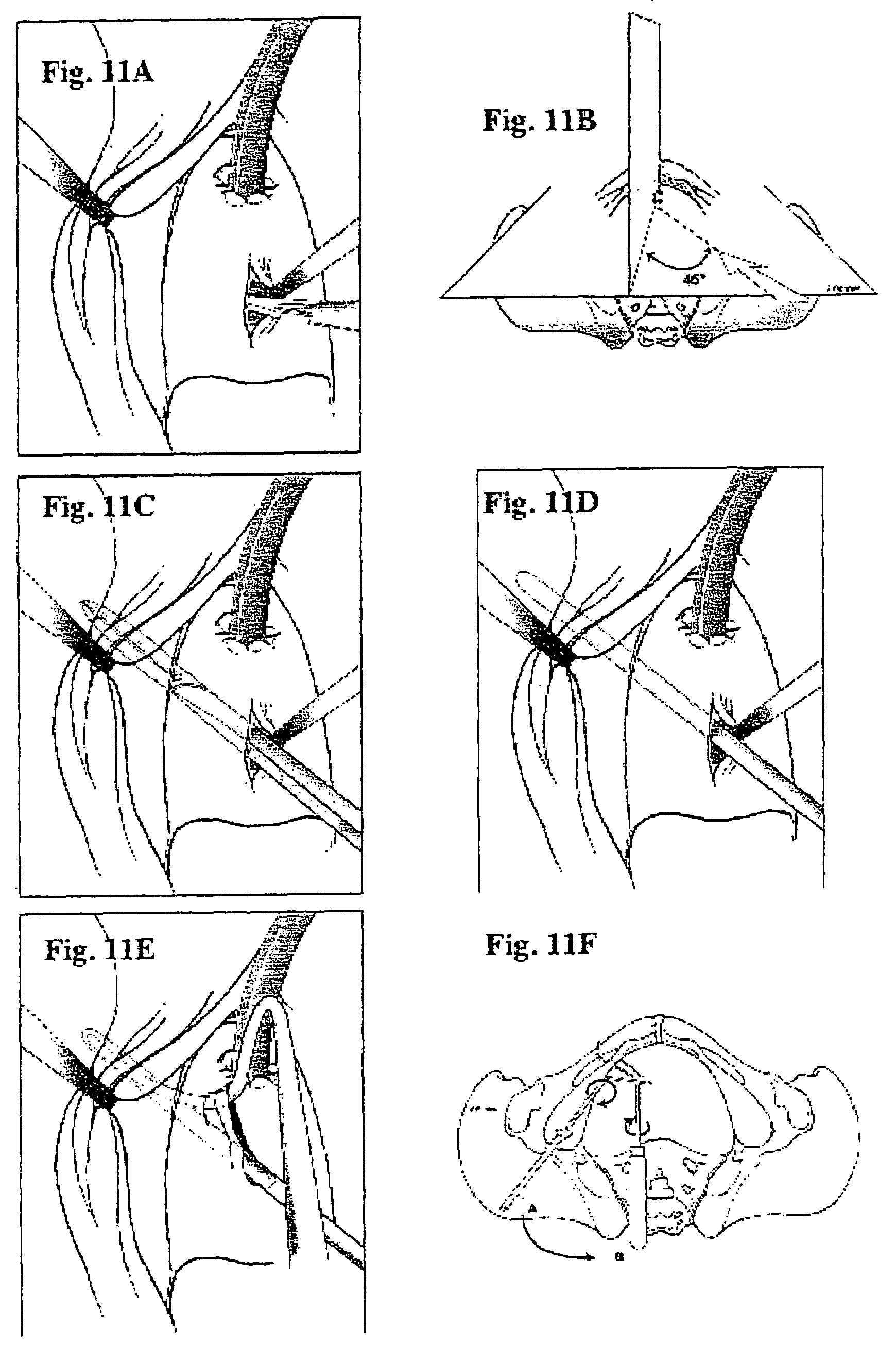 Patent US7204802 Surgical procedure for the treatment of female