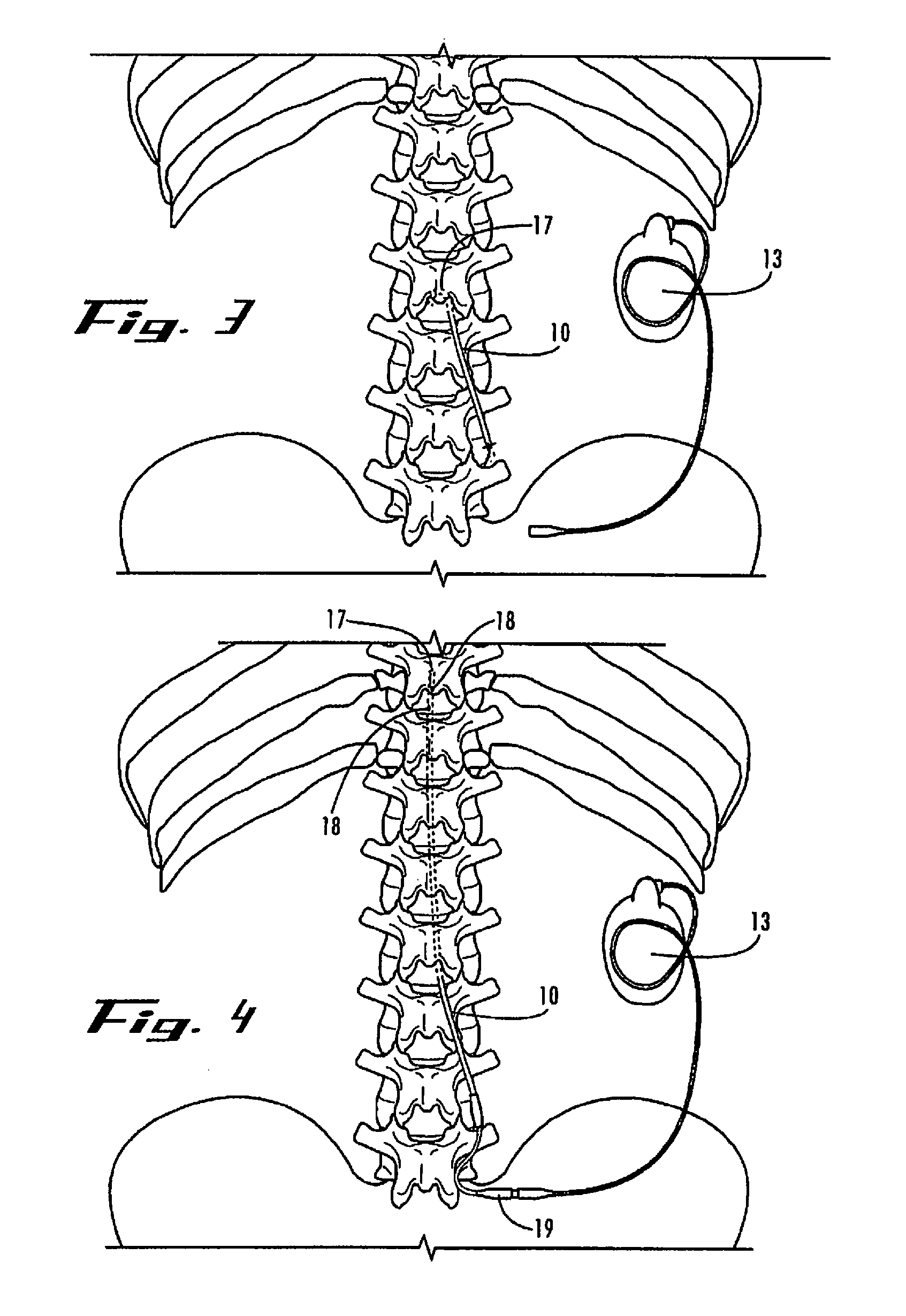 intrathecal catheter having a stylet with a curved tip and