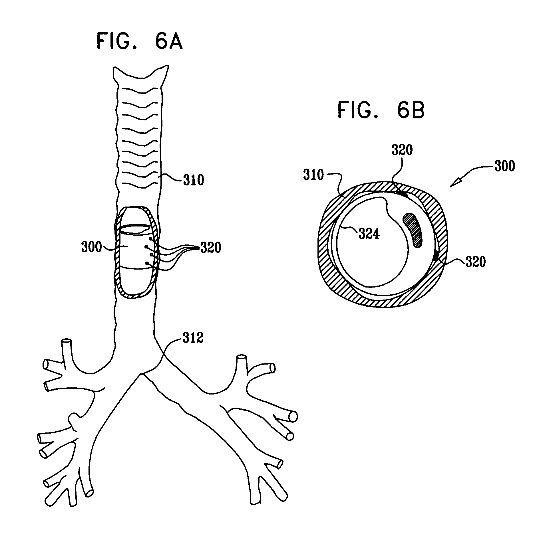 parasympathetic stimulation for termination of non