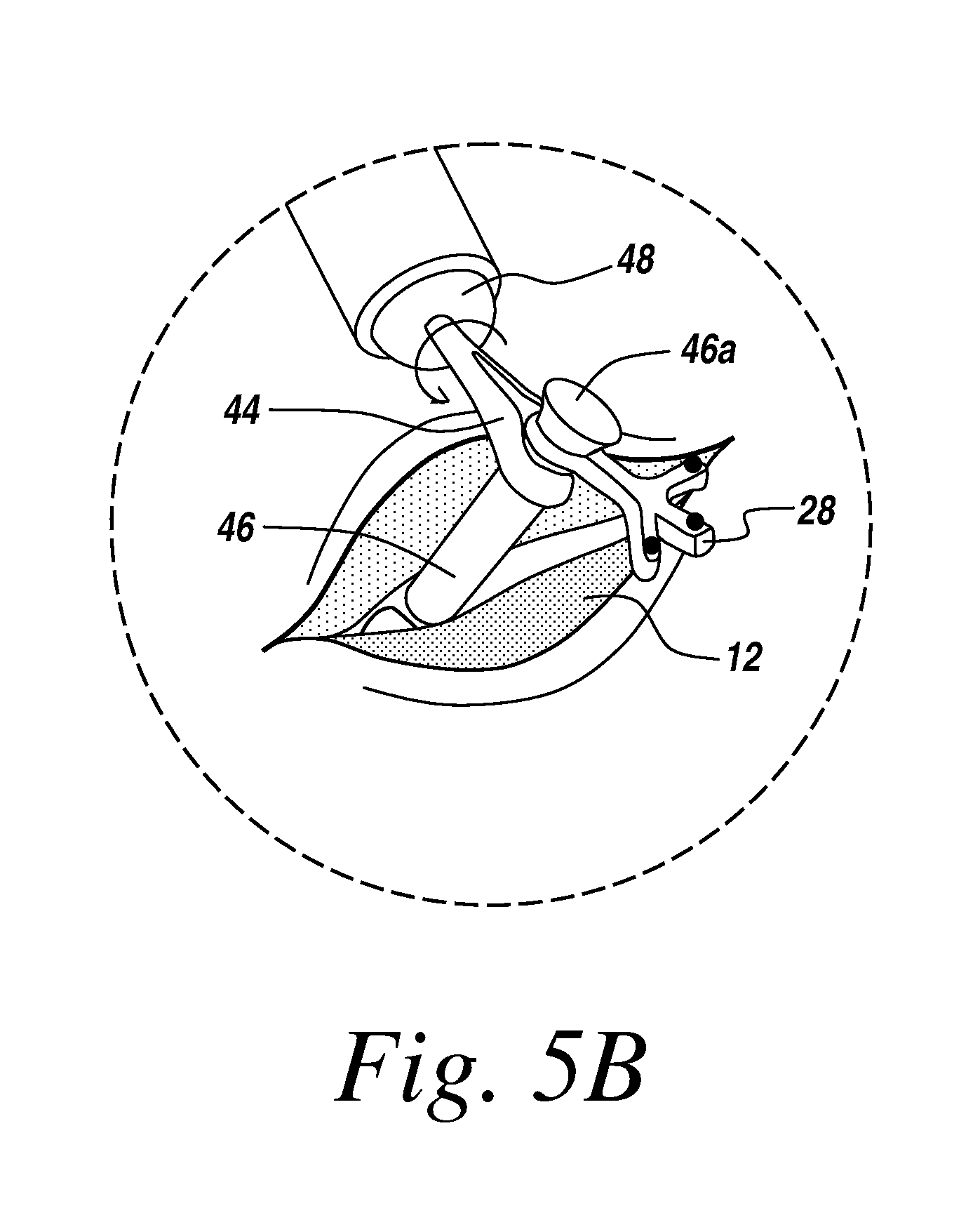 rigidly guided implant placement