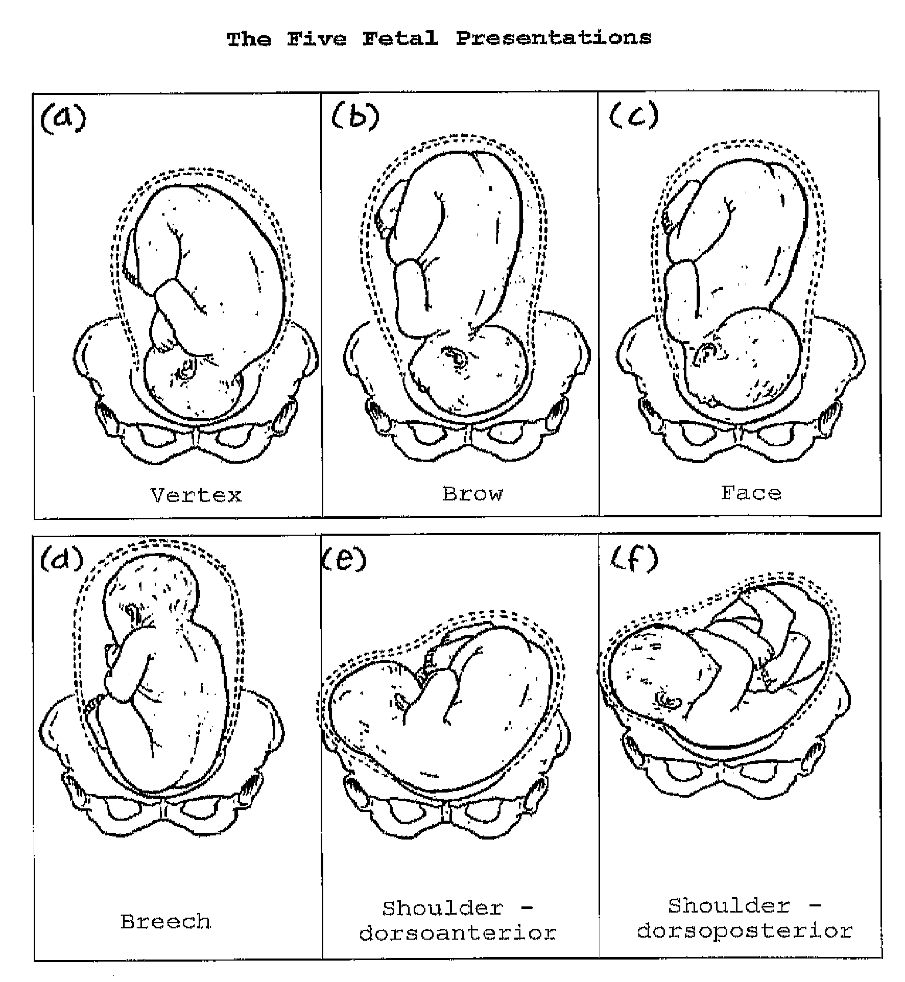 fetal presentation