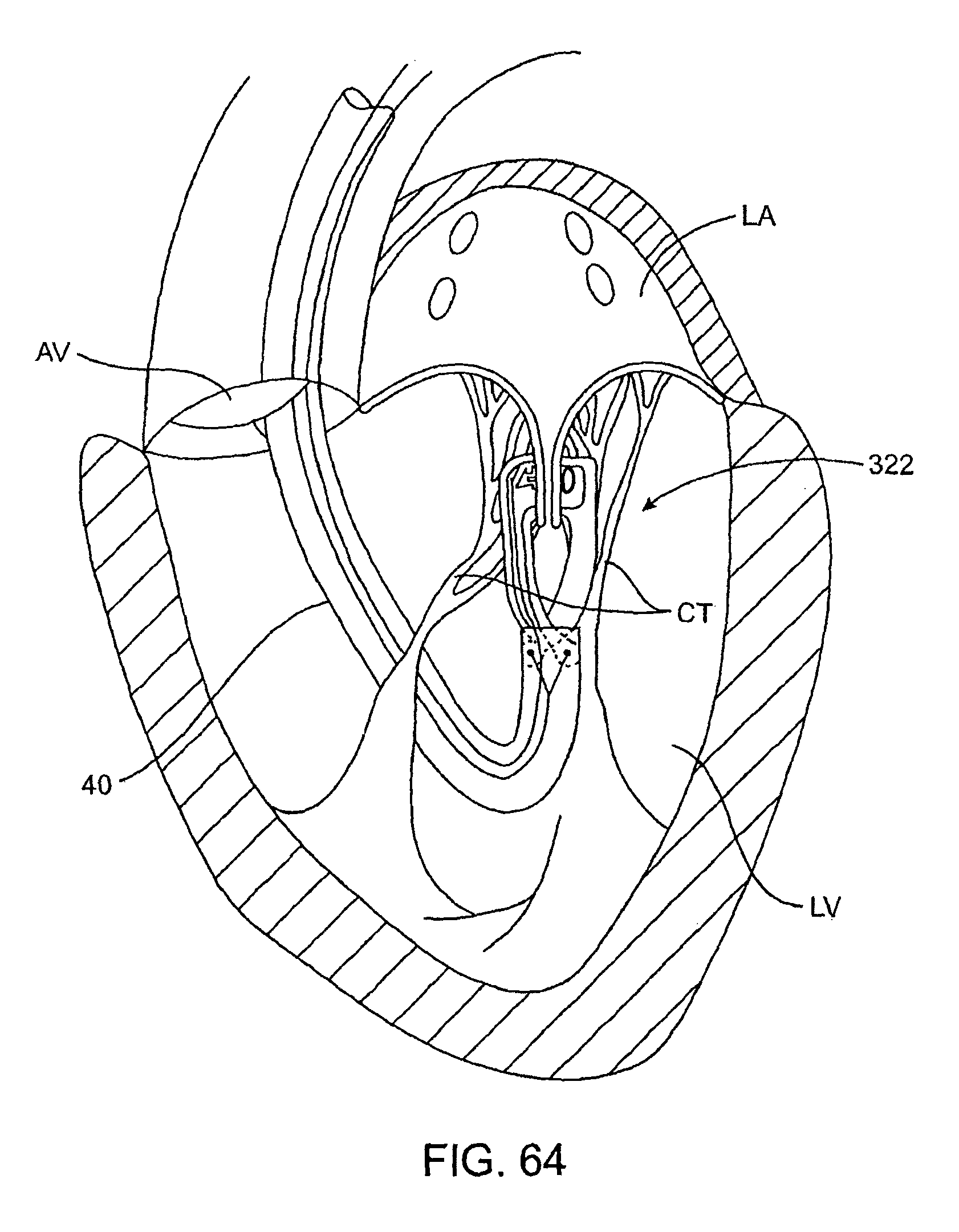 methods and apparatus for cardiac valve repair