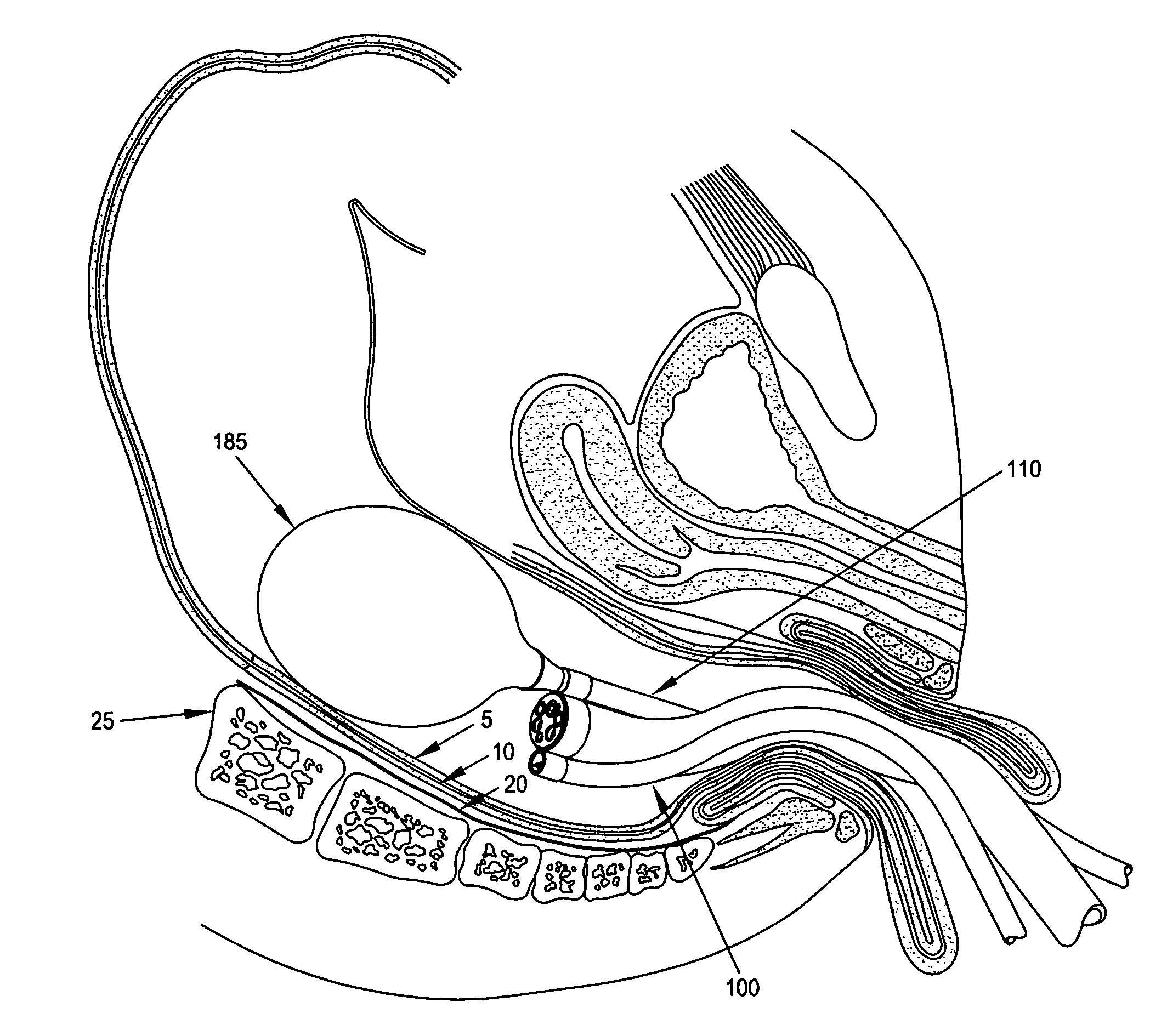 Patent US8430890 - Method and apparatus for endoscopically ...
Rectum Drawing