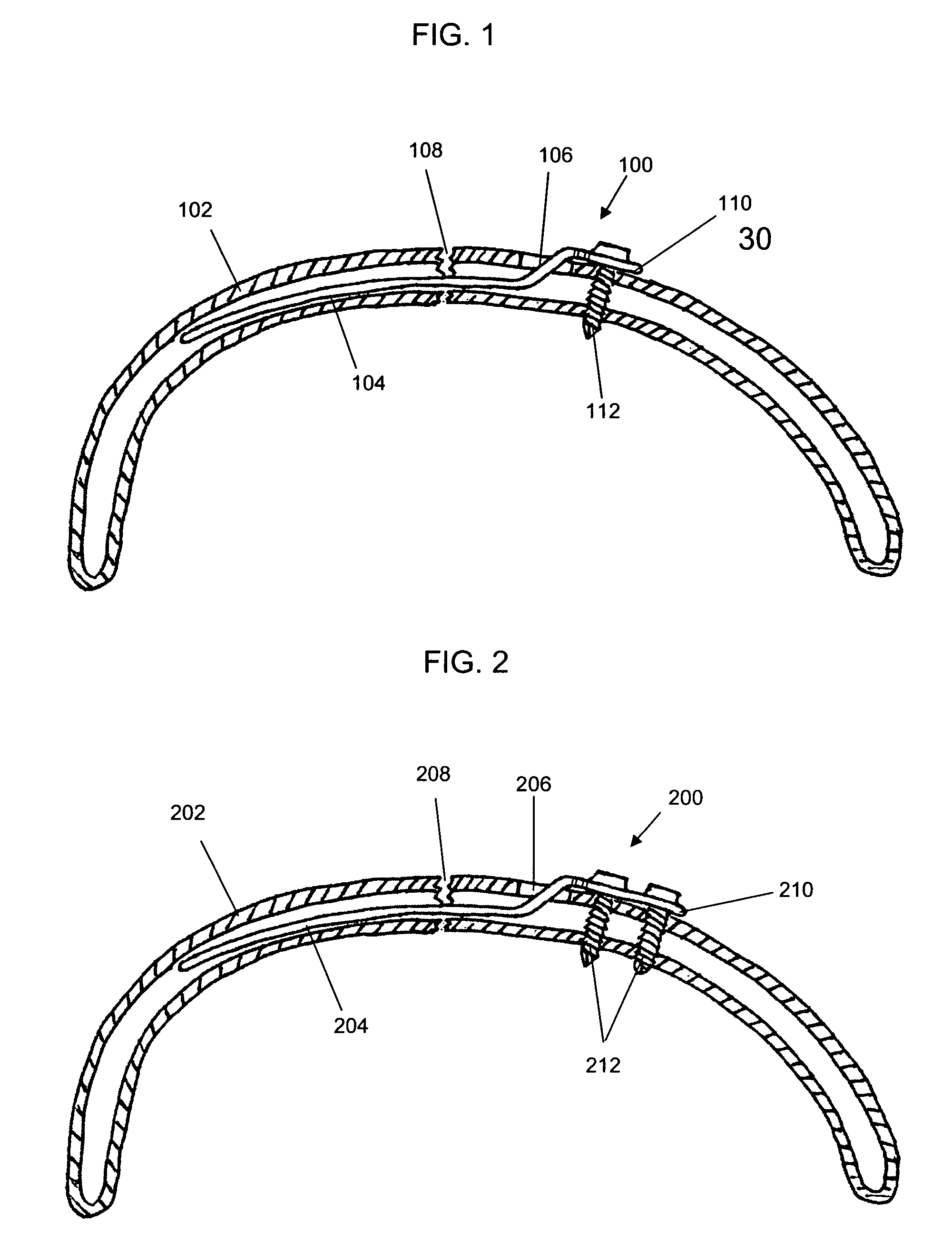 osteosynthesis method osteosynthesis method